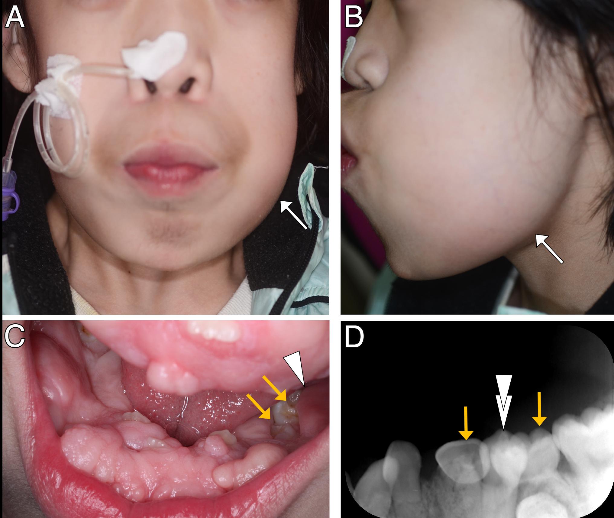 Clinical and X-ray photographic findings at first facial 
swelling. (A) Frontal view of the face. (B) Lateral view of the face. (C) 
Intraoral view. (D) X-ray image. White arrow indicates facial swelling. Yellow 
arrows indicate lower left deciduous molars. Arrowhead indicates redness and 
swelling of the gingiva in (C). Double arrowhead indicates the lower left first 
premolar in (D).