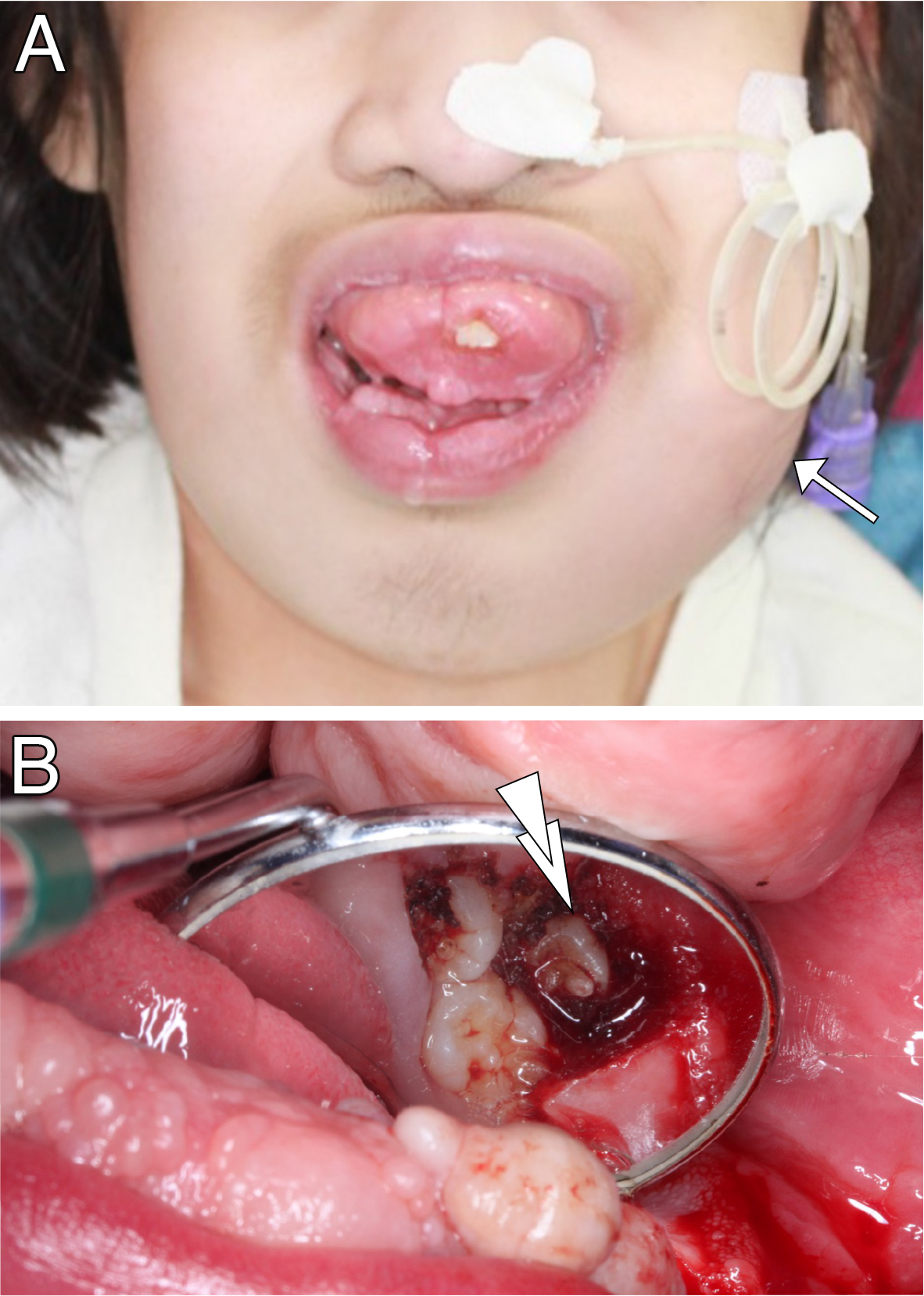 Clinical findings with the third episode of facial swelling (A) 
and at surgery (B). (A) Recurrent facial swelling. (B) Mirror image of the 
intraoral view immediately after surgery. White arrow indicates facial swelling. 
Double arrowhead indicates the lower left first premolar with central tubercle.