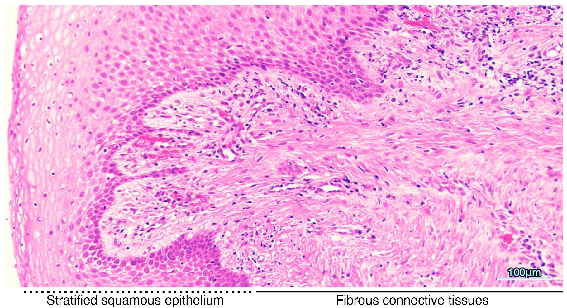 Histological image of the resected gingiva at the time of 
surgery (hematoxylin and eosin, original magnification ×4). Infiltration of inflammatory cells is apparent. Dotted line indicates stratified 
squamous epithelium. Solid line indicates fibrous connective tissues. Scale bar; 
100 μm.