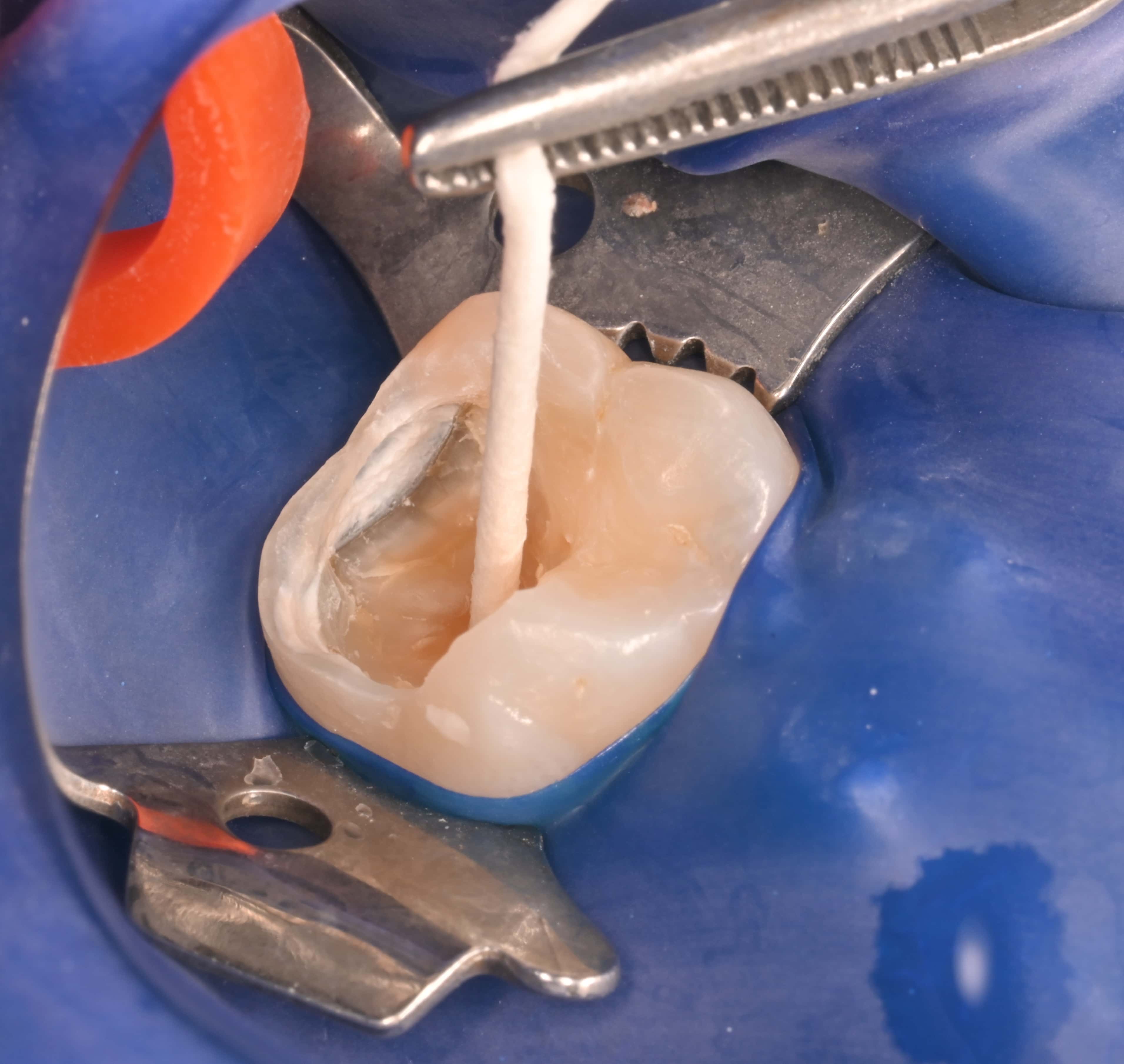 Collection of the microbiological sample from the carious 
lesion.