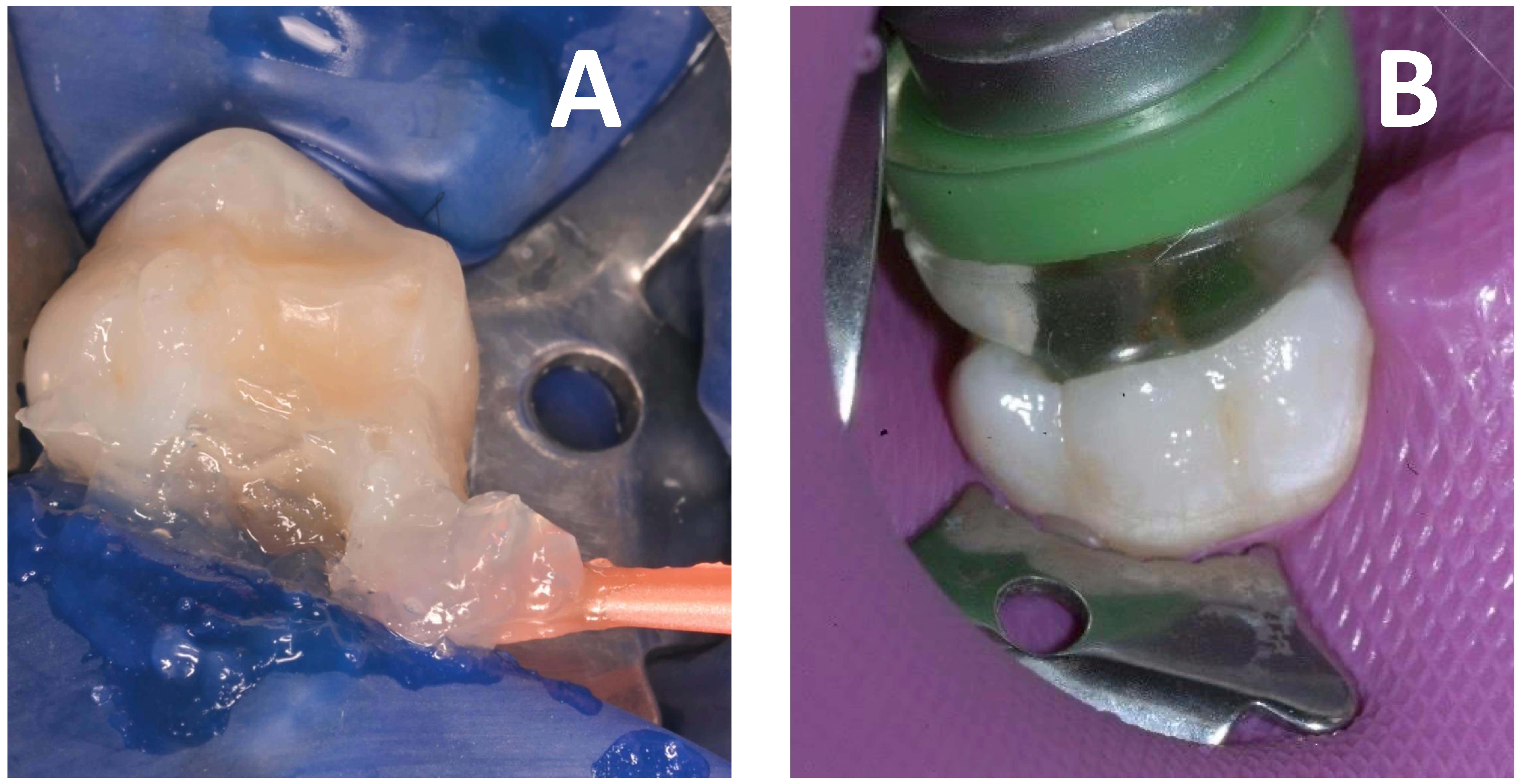Ozone applications. (A) Application of ozonized gel (GeliO3), 
and (B) ozonized gas (healOzone).