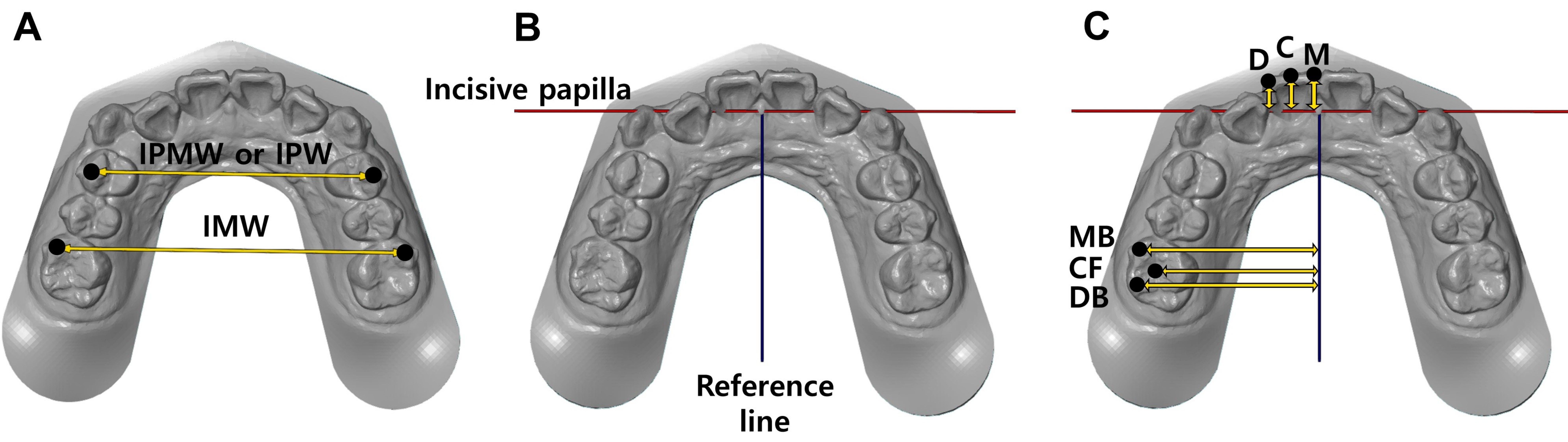 Arch width and tooth position. (A) Arch widths. The widths were 
calculated by measuring interprimary molar width (IPMW) or interpremolar width 
(IPW) and intermolar width (IMW). (B) Establishment of the reference lines for 
tooth position. A vertical line was drawn through the midline of the incisal 
papilla (black line) and a perpendicular line to the black line (red line) was 
drawn penetrating the center of the incisal papilla. (C) Position of maxillary 
first incisors and first molars. The distance between the tooth and the reference 
line was measured. For each tooth, the measurement was performed at 3 points. M, 
mesial point of incisal edge; C, central point of incisal edge; D, distal point 
of incisal edge; MB, mesiobuccal cusp tip; CF, central fossa; DB, distobuccal 
cusp tip.