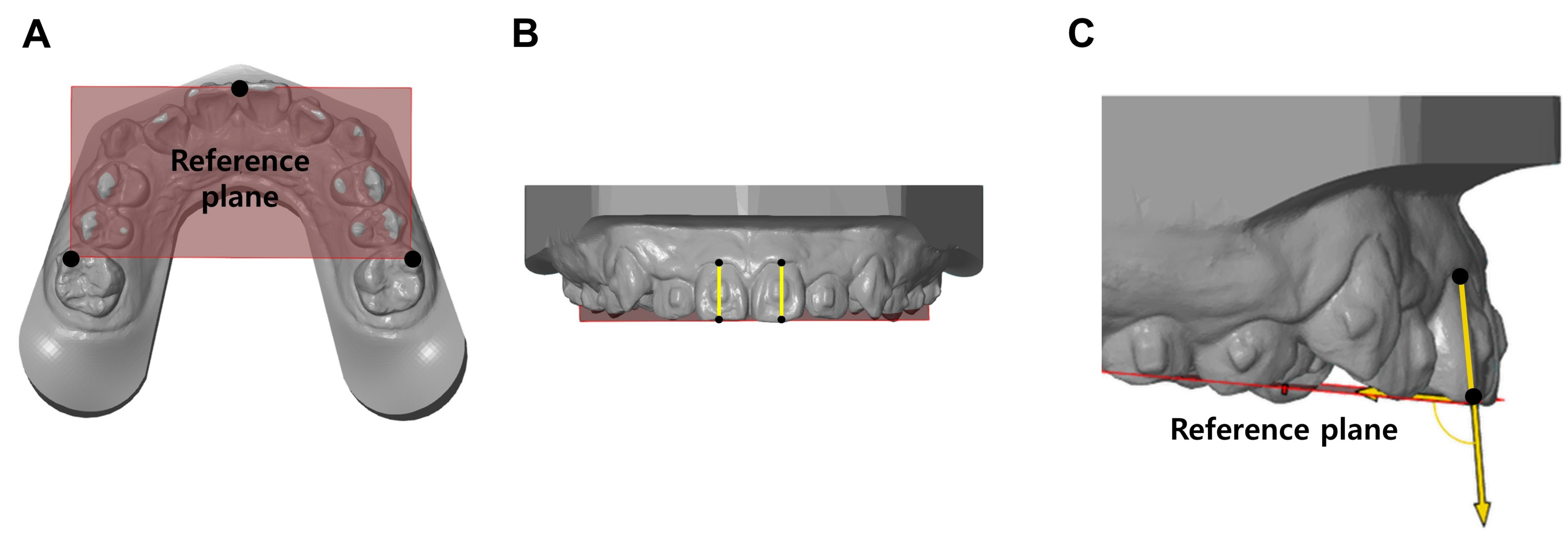 Torque of maxillary first incisors. (A) Establishment of the 
reference plane. The plane was set as a tripod of points from the contact point 
between the incisal edges of maxillary first incisors and the cusp tips of the 
mesiobuccal cusps of the maxillary first molars. (B) Establishment of the 
reference line. The line (yellow line) was drawn from the midpoint of the 
cervical margin to the midpoint of the incisal edge of the maxillary first 
incisors. (C) Torque measurement. Torque was measured as the angle between the 
reference line and plane.