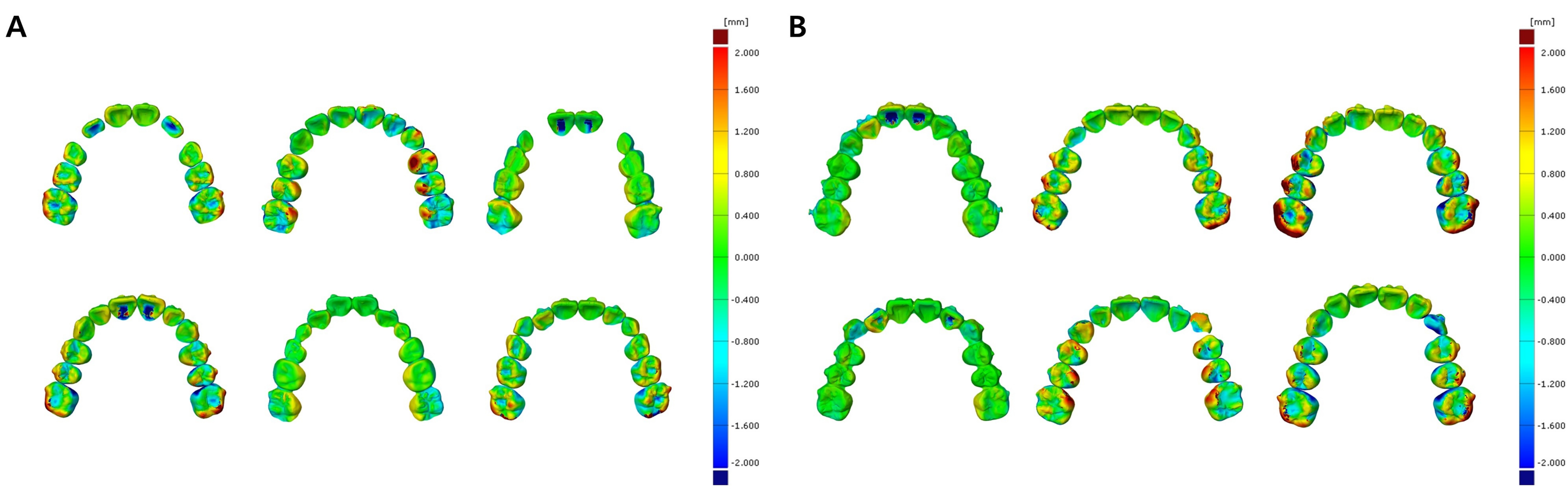 The discrepancy between predicted and achieved tooth models. 
(A) Mixed-dentition group. (B) Permanent-dentition group. The amount of 
discrepancy is presented by color-coded mapping. Typical images are shown, and 
some images are hidden.