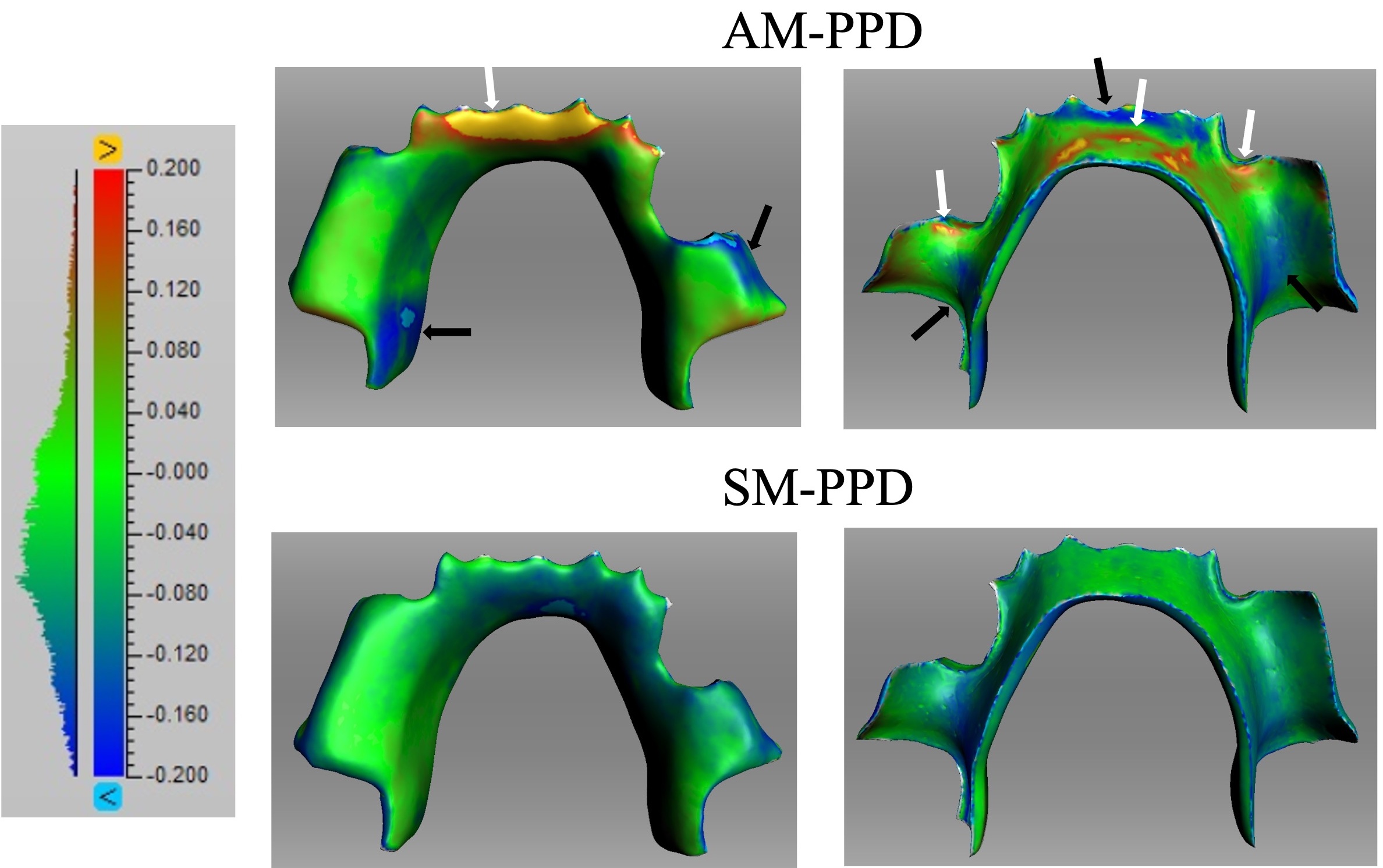 AM-PPD and SM-PPD color mapping. For
AM-PPD, a yellow (positive deviation) color was observed on the mucosal surface
in the mesial area that is in contact with the anterior mandibular teeth of the
lingual alveolar ridge, left deciduous canine, and the right primary molar, as
well as on the area corresponding to the anterior mandibular teeth on the
polished surface (⇒). Blue (negative deviation) was observed in the anterior
mandibular teeth, the area corresponding to the part of the alveolar ridge apex
on the left side with missing teeth, and on the lingual side of the first molars
on both sides of the mandible on the mucosal surface and the lingual side of the
left first molar and the buccal side of the area with missing teeth, on the right
side on the polished surface (→). For SM-PPD, no yellow or red (positive
deviation) coloring was observed on the polished and mucosal surfaces, and
overall, the map showed light green to green, which indicates that the deviation
was within the allowable range. Blue (negative deviation) was observed on areas
such as the mucosal surfaces of the parts of the alveolar crest with missing
teeth and the polished surfaces of the anterior mandibular teeth. AM: additive
manufacturing; PPD: pediatric partial denture; SM: subtractive manufacturing.