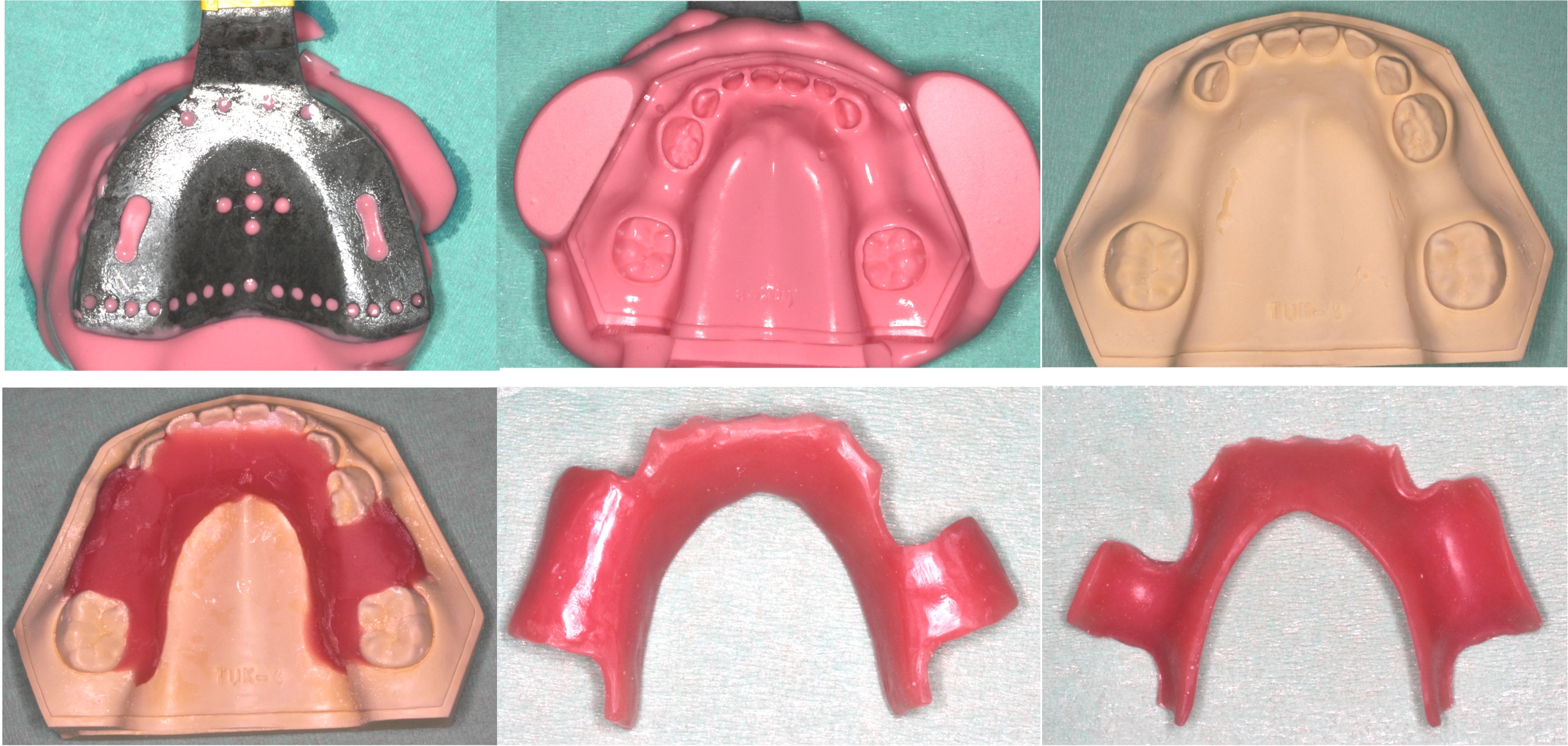 Manufacturing of the pediatric partial denture using
conventional method (control).