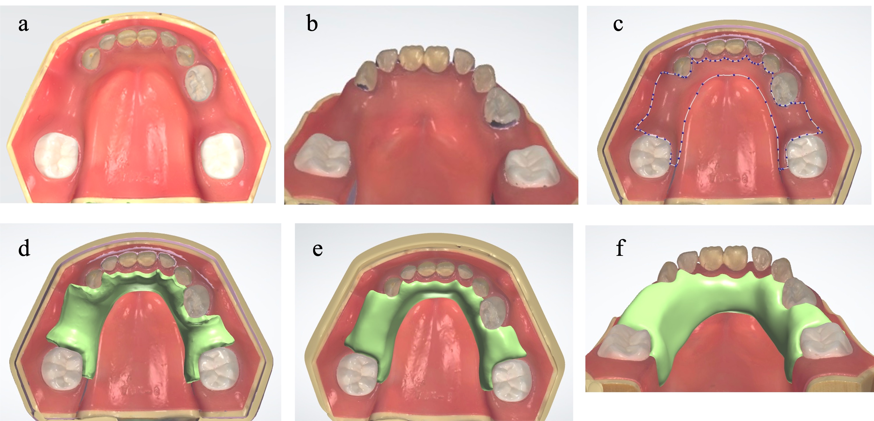 Pediatric partial denture design using computer-aided
design software. (a) An optical impression of the mucosal anatomical jaw model
was recorded using an intraoral scanner. (b) Blocking out of the undercut area.
(c) Pediatric partial denture outline settings. (d) A 0.2-mm wax-up was applied
to the outline. (e) Occlusal view of the completed design. (f) Lingual view of
the completed design.