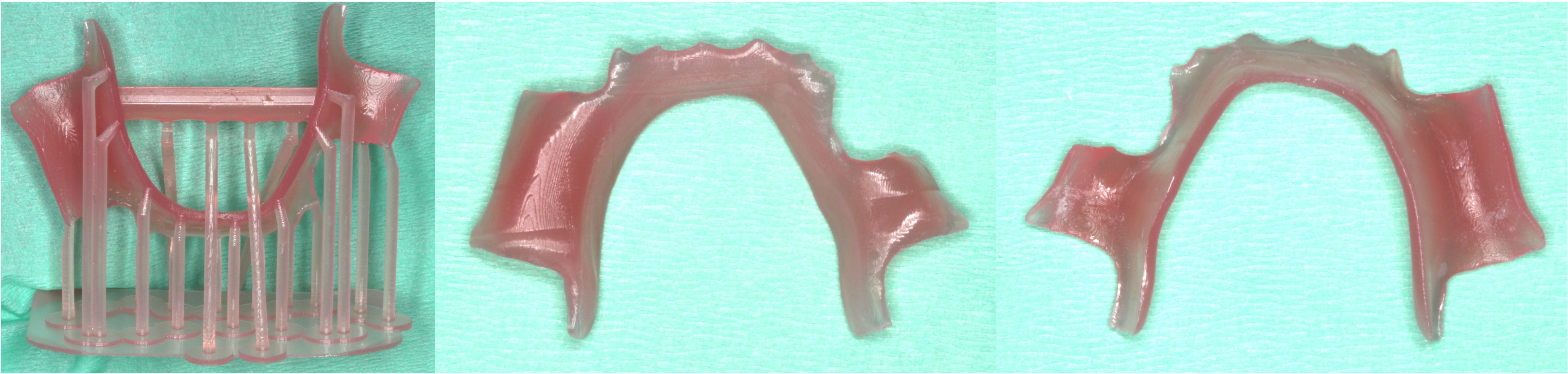 Manufacturing of the pediatric partial denture using
additive manufacturing.