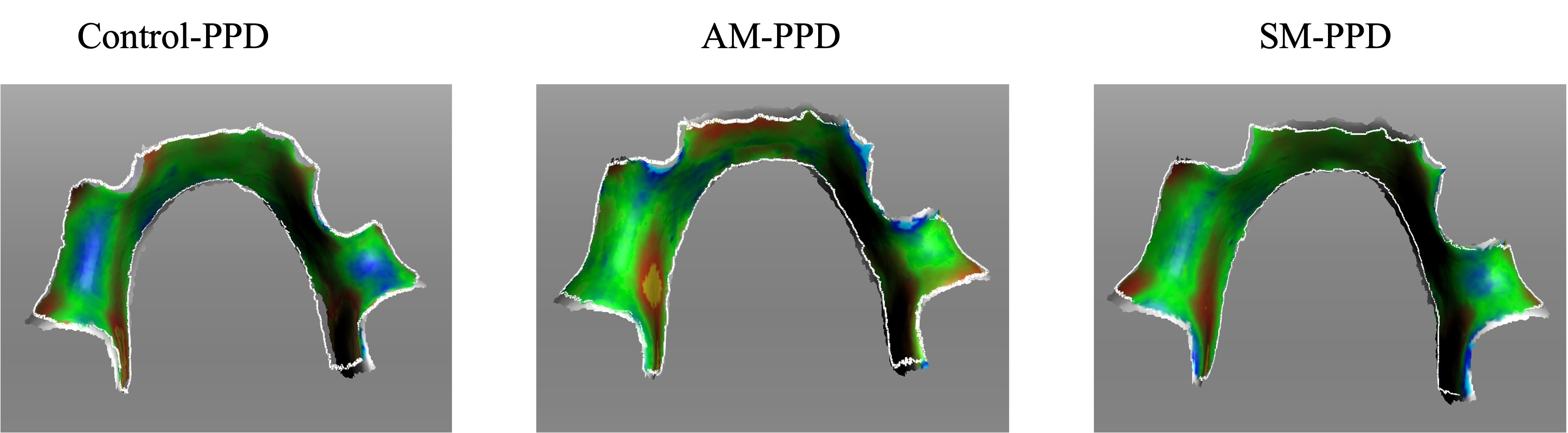 Mucosal surface of the jaw model and each PPD color mapping.
Each color mapping shows the state of fit between the mucosal surface of the jaw
model and each PPD. The control-PPD showed blue (negative deviation) at the area
corresponding to the part of the alveolar ridge apex and yellow or red (positive
deviation) in the transition area of the missing mandibular first molar from the
lingual side. AM-PPD showed yellow or red (positive deviation) in the lingual
crest of the anterior mandibular teeth and in the transition area from the
lingual side of the mandibular first molars to the missing area. SM-PPD showed
red (positive deviation) in the transition area of the missing mandibular first
molar from the lingual side and in the labial floor margin of the missing area.
AM: additive manufacturing; PPD: pediatric partial denture; SM: subtractive
manufacturing.