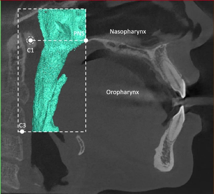 3D image of the pharyngeal airway on CBCT. The region superior
to the plane passes through the two points of the PNS on both sides and the first
cervical vertebra (C1). The region inferior to the plane passes through the two
points of the PNS on both sides and the first cervical vertebra (C1).