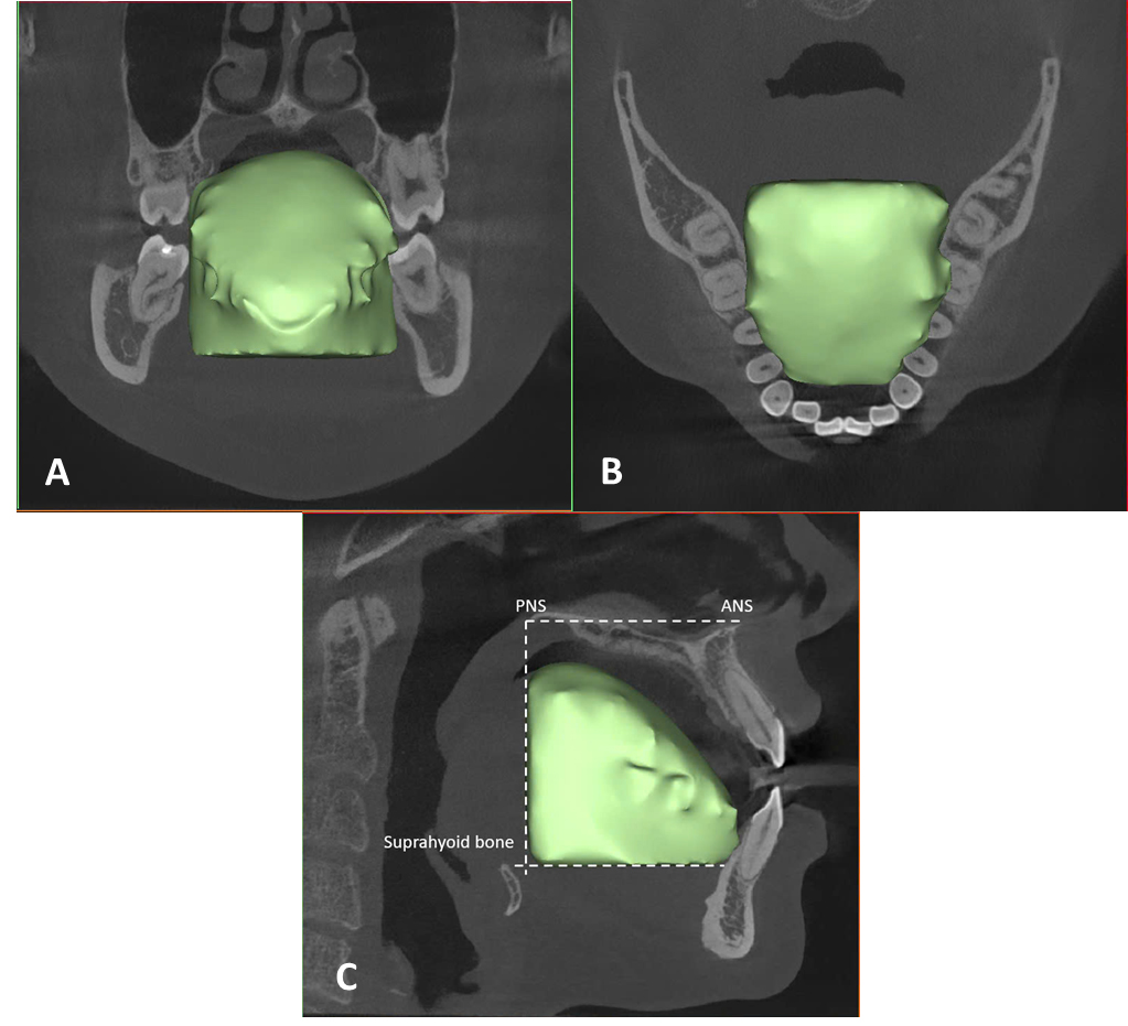 Assessment of TV on CBCT: (A) coronal plane, (B) axial plane and
(C) sagittal plane. The plane that passes through the ANS and PNS was considered
standard. The inferior border of the tongue was defined as the plane passing
through the upper limit of the hyoid bone and parallel to the palatal plane. The
posterior border of the tongue was determined by a line perpendicular to the
PNS-ANS and a line parallel to the PNS-ANS and passing through the superior
border of the hyoid bone. The front and upper parts followed the tongue’s
curvature in the OP. The tongue was manually separated with Hounsfield and gray
values for the soft tissue scan tool. The inside of the tongue was smeared on
each of the axial, coronal and sagittal planes, and the TV was calculated.