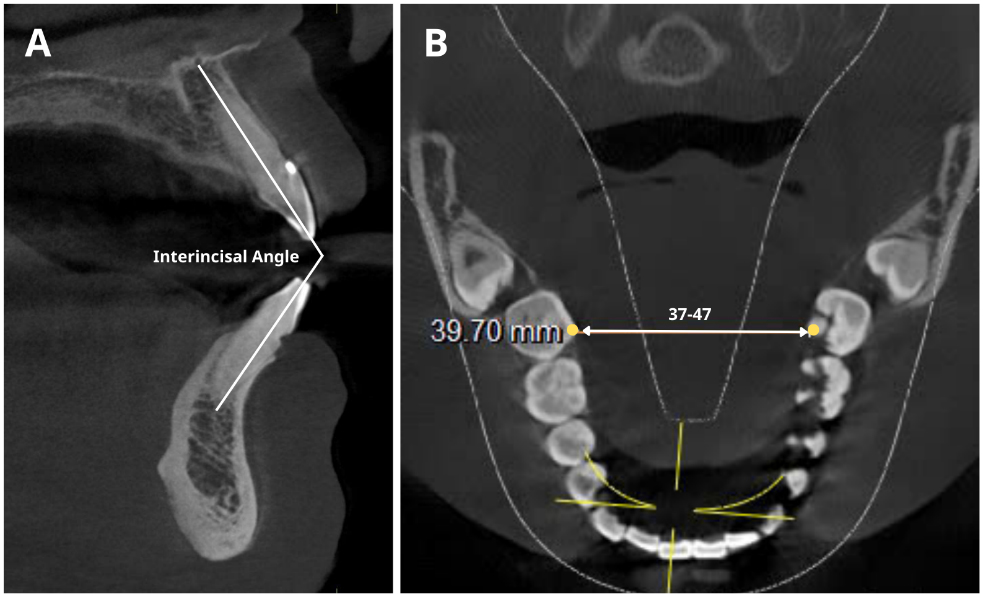 Anatomical measurements of the tongue on CBCT images: (A)
cross-sectional plane and (B) axial plane.