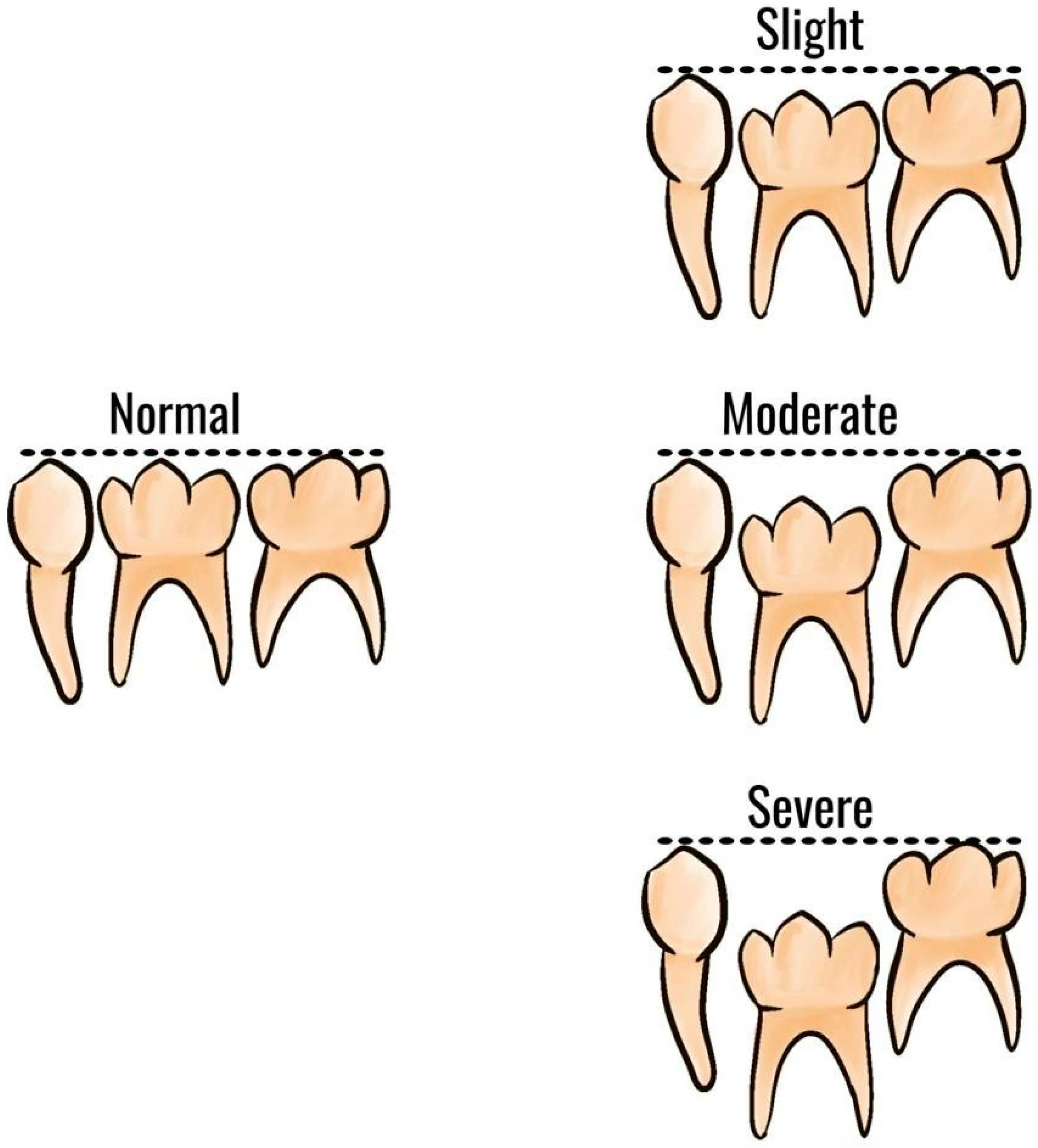 Classification of infraocclusion severity according to 
Brearley and McKibben [27].