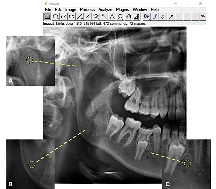 ROIs: region of interests. (A) ROI-1: Mandibular
condyle. (B) ROI-2: Centre of mandibular angle. (C) ROI-3: Mandibular molar area.
