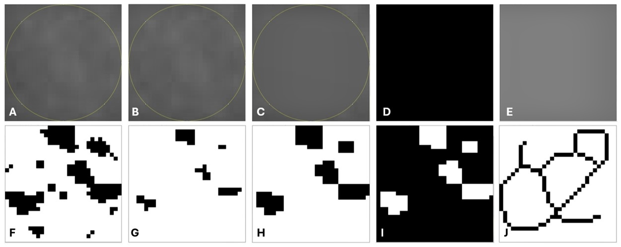 Image processing steps for fractal analysis. (A) Cropped
grayscale image. (B) Duplicated image. (C) A Gaussian blur filter (sigma = 35
pixels) is applied to minimize brightness variations caused by overlapping soft
tissues and differences in bone thickness. (D) Subtracted image to enhance edges.
(E) Image with added intensity (128) for normalization. (F) Binarized
(black-and-white) image. (G) Eroded image for noise reduction. (H) Dilated image
to enhance structures. (I) Inverted binary image for better outline visibility.
(J) Skeletonized image for structural simplification.