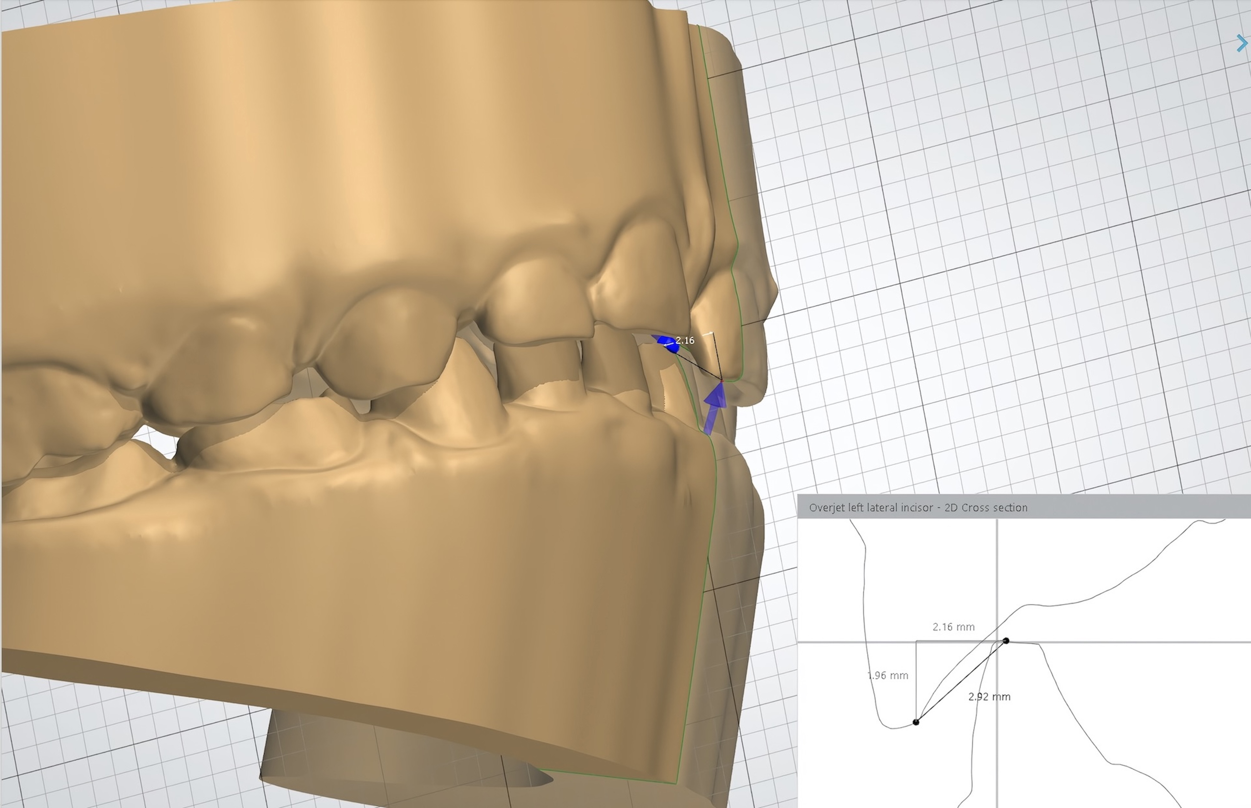 Measurement of
overjet-overbite values on the digital model (2D: two-dimensional).