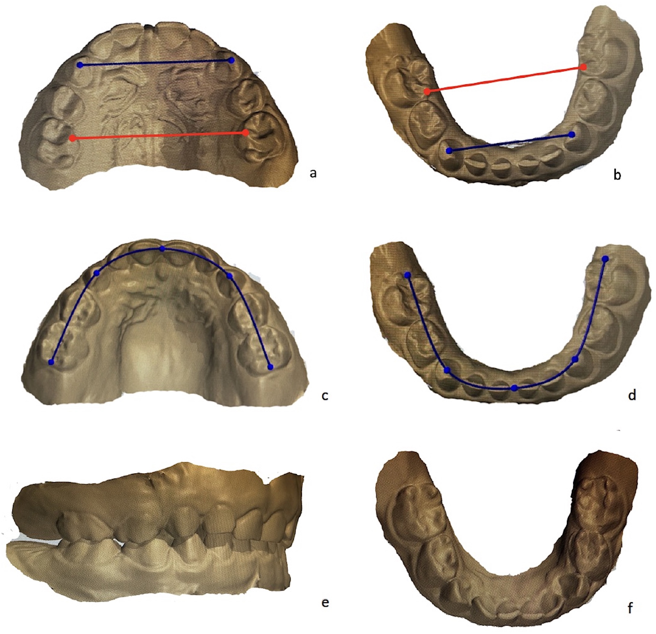 Measurement of inter-canine
width (a,b (blue arrow)), inter-molar width (a,b (red arrow)) and arch length
(c,d) values on the digital model. Determining the occlusion relationships of
primary molar and canine teeth (e) and presence/absence of crowding,
physiological and primate spaces (f) on the digital model.