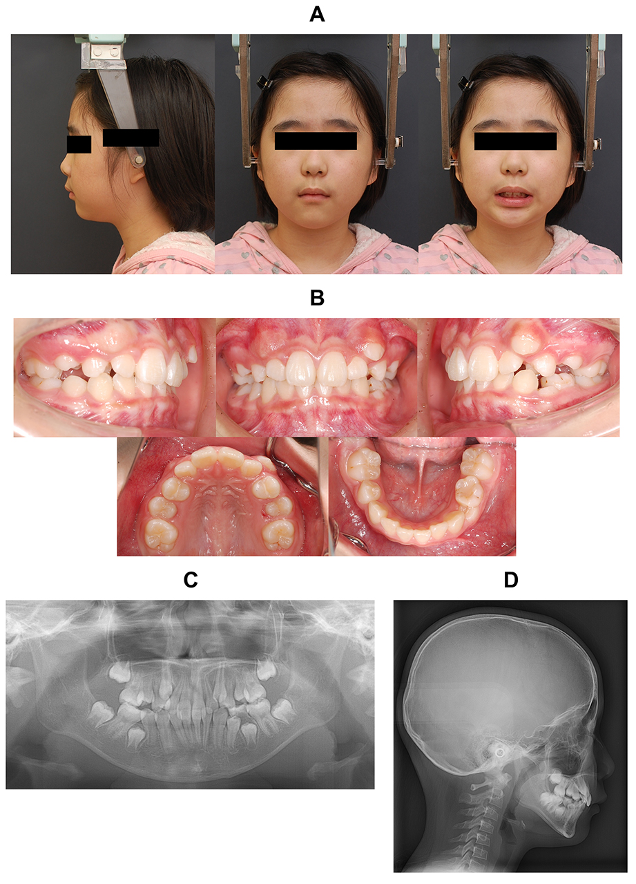Findings at initial presentation. (A) Facial photographs. (B) 
Intraoral photographs. (C) Panoramic radiograph. (D) Lateral cephalometric 
radiograph.
