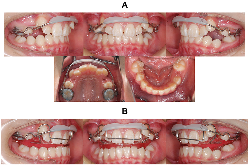 Intraoral photographs with appliances. (A) Lip bumper. (B) 
Bionator.