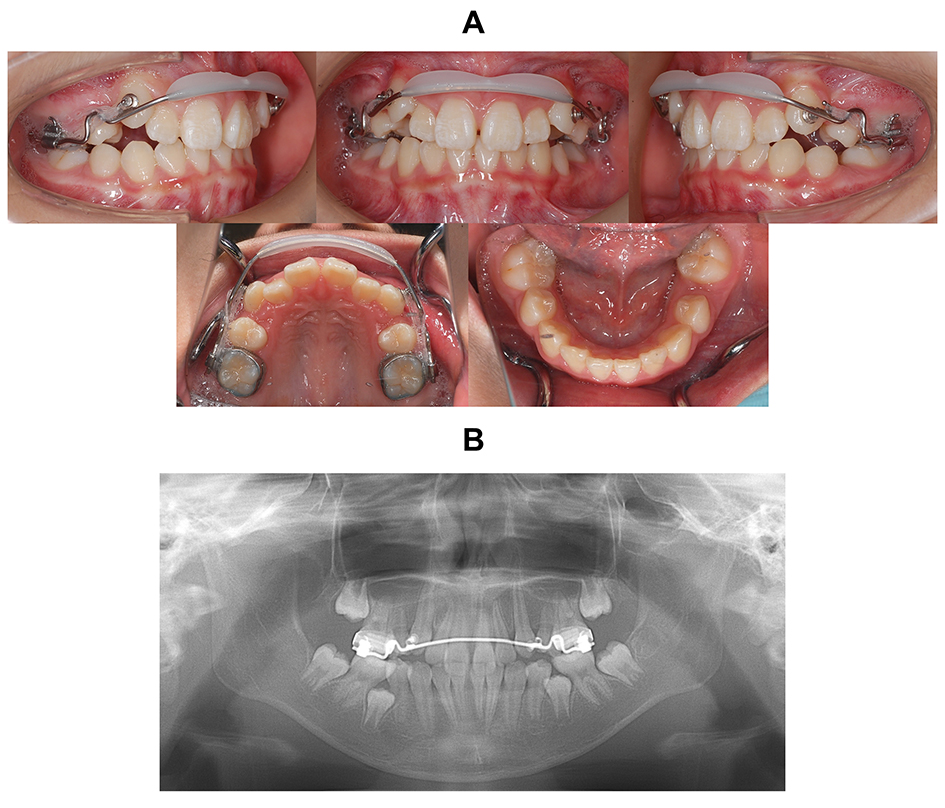 Intraoral photographs with appliances. (A) Traction of the 
maxillary bilateral canines were started. (B) Panoramic radiograph.