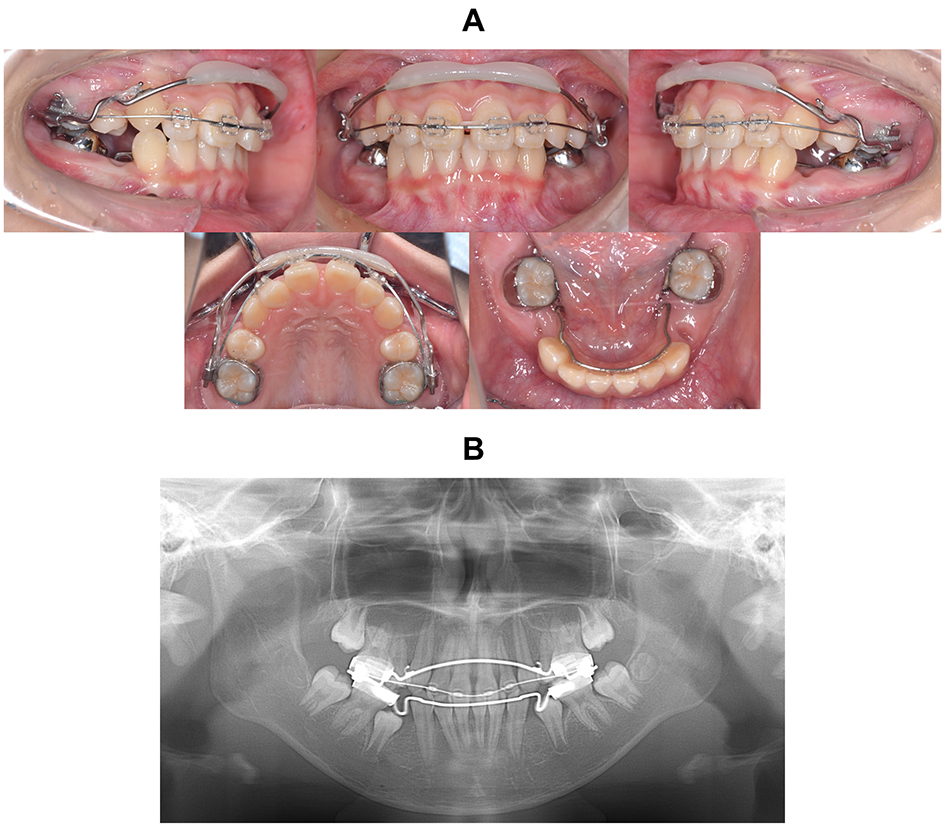 Intraoral photographs with appliances. (A) Maxillary, sectional 
arch and lip bumper; mandibular, lingual arch. (B) Panoramic radiograph.