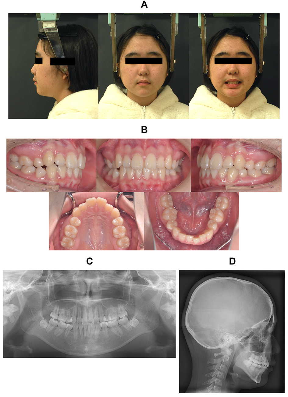 Findings at the end of phase 1 treatment (at the beginning of 
phase 2 treatment). (A) Facial photographs. (B) Intraoral photographs. (C) 
Panoramic radiograph. (D) Lateral cephalometric radiograph.