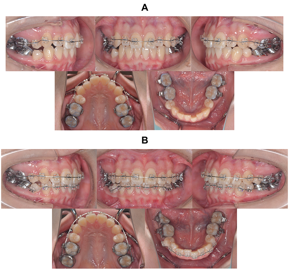 Intraoral photographs with appliances. (A) Multi-bracket 
appliance applied to the maxillary arch. (B) Multi-bracket appliance applied to 
the mandibular arch.