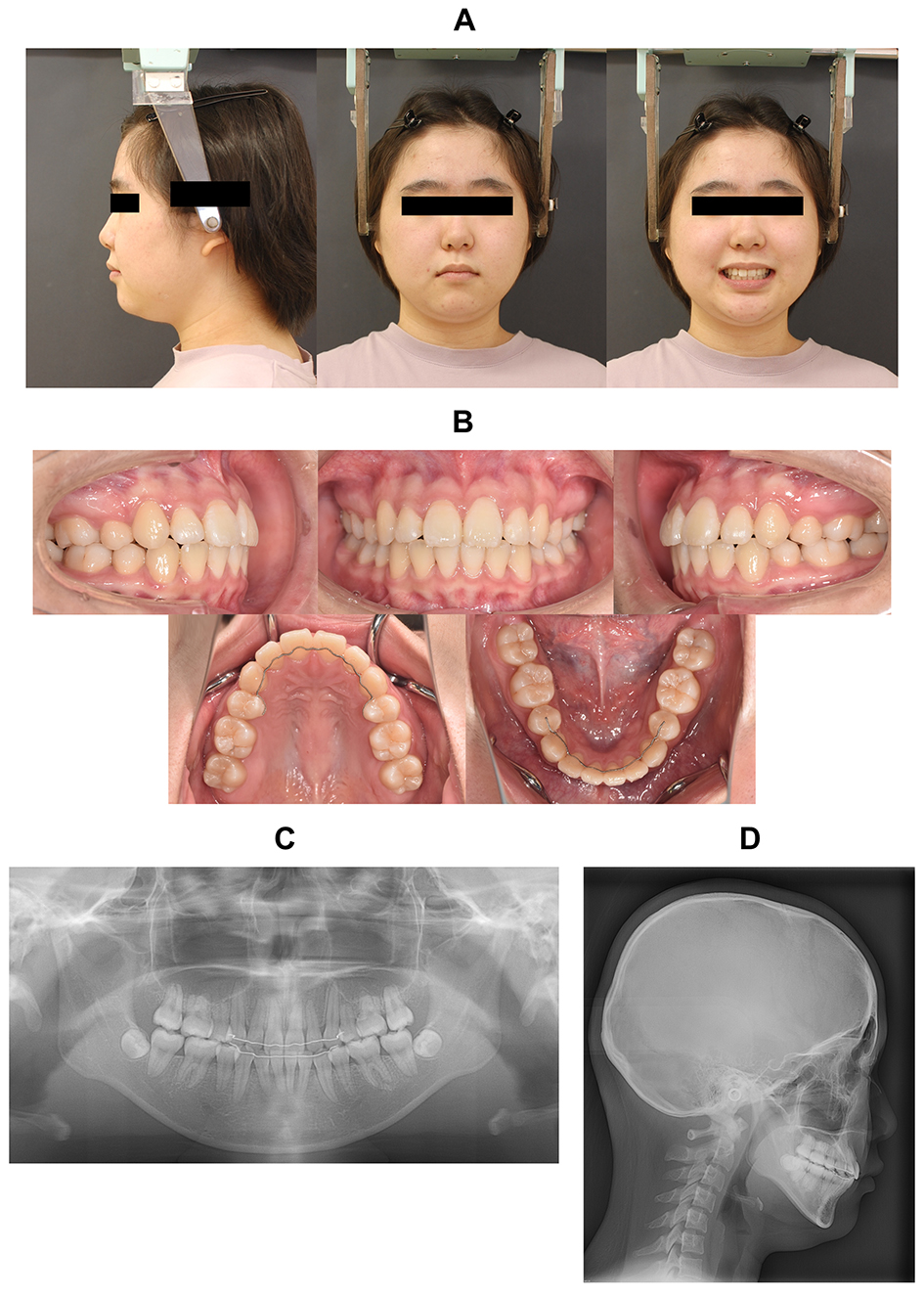 Findings at the end of dynamic treatment. (A) Facial 
photographs. (B) Intraoral photographs. (C) Panoramic radiograph. (D) Lateral 
cephalometric radiograph.