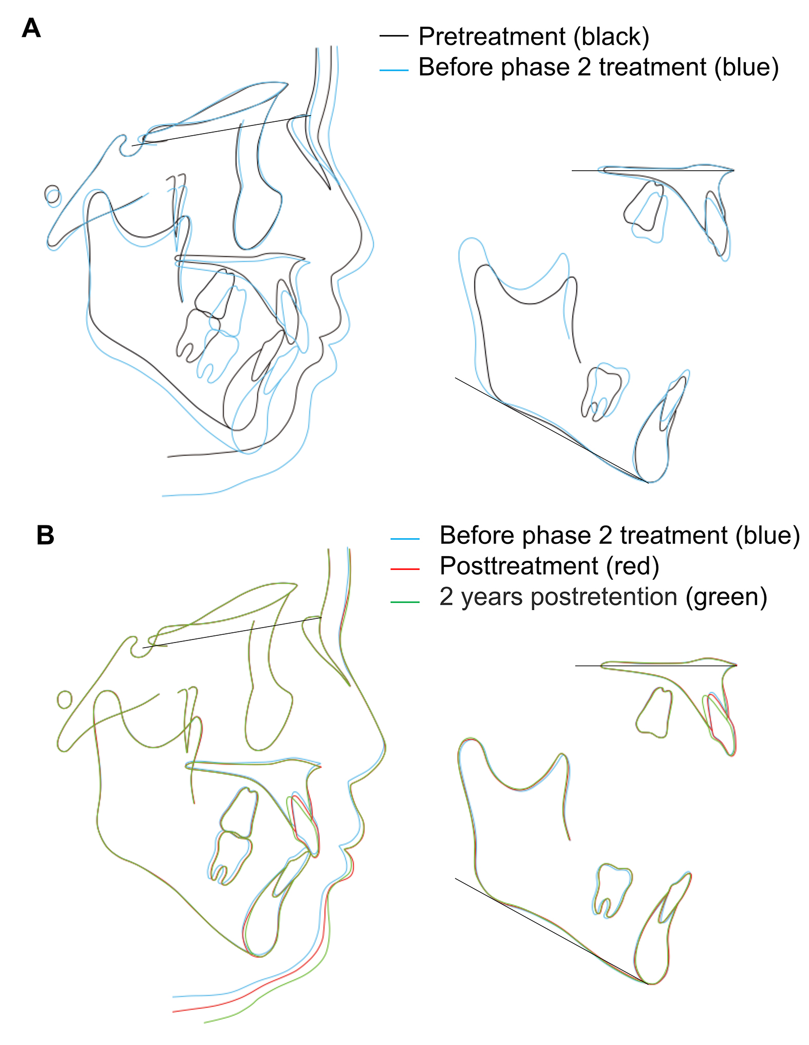 Cephalometric superimposition. (A) Pretreatment (10 y 7 m) and 
before phase 2 treatment (15 y 1 m). (B) Before phase 2 treatment (15 y 1 m), 
posttreatment (16 y 6 m) and postretention (18 y 6 m).