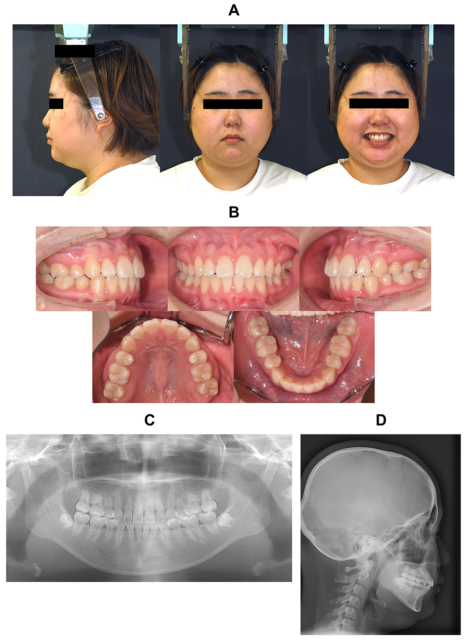 Findings at the end of postretention. (A) Facial photographs. 
(B) Intraoral photographs. (C) Panoramic radiograph. (D) Lateral cephalometric 
radiograph.