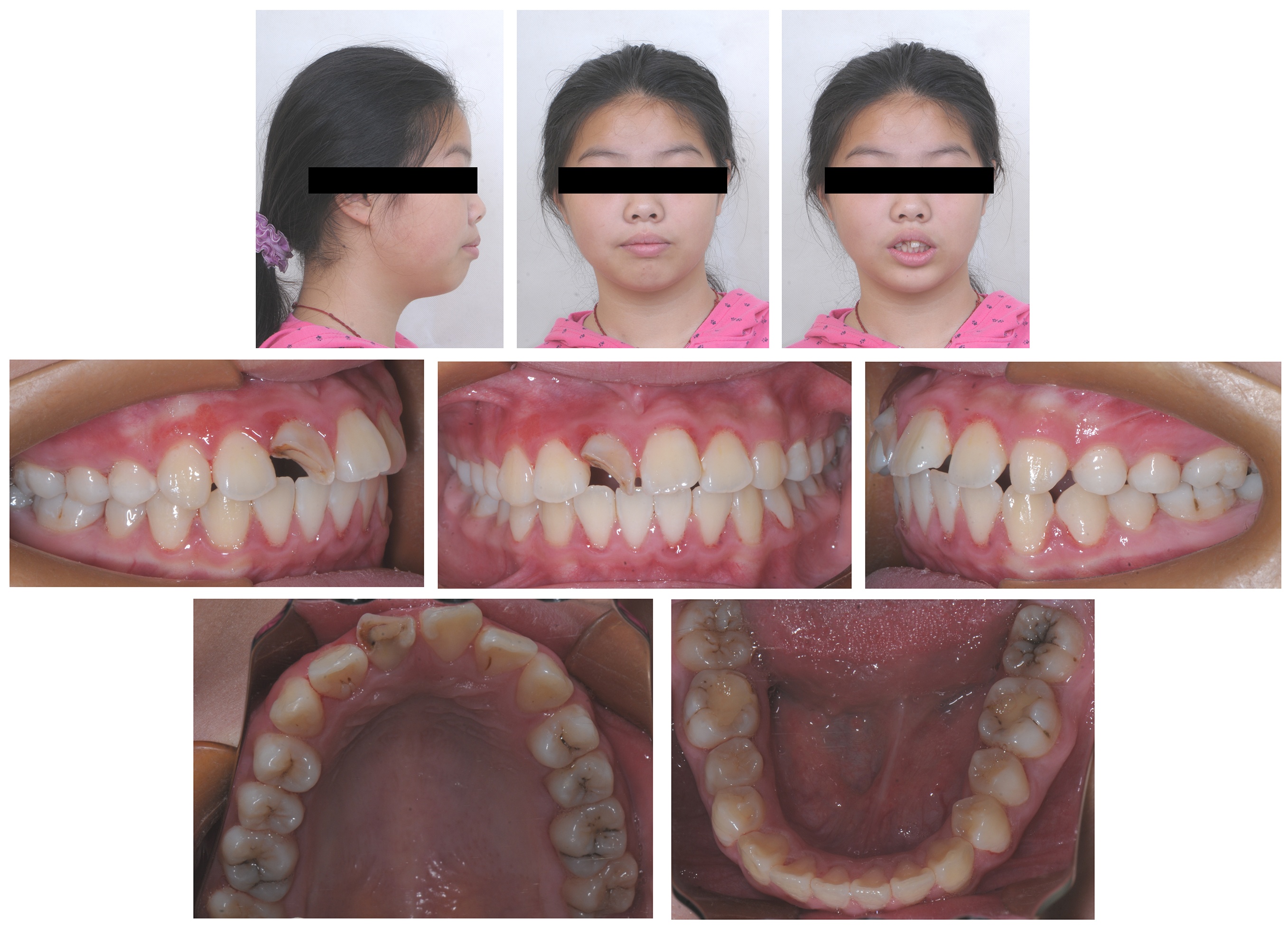Pretreatment facial and intraoral photographs.