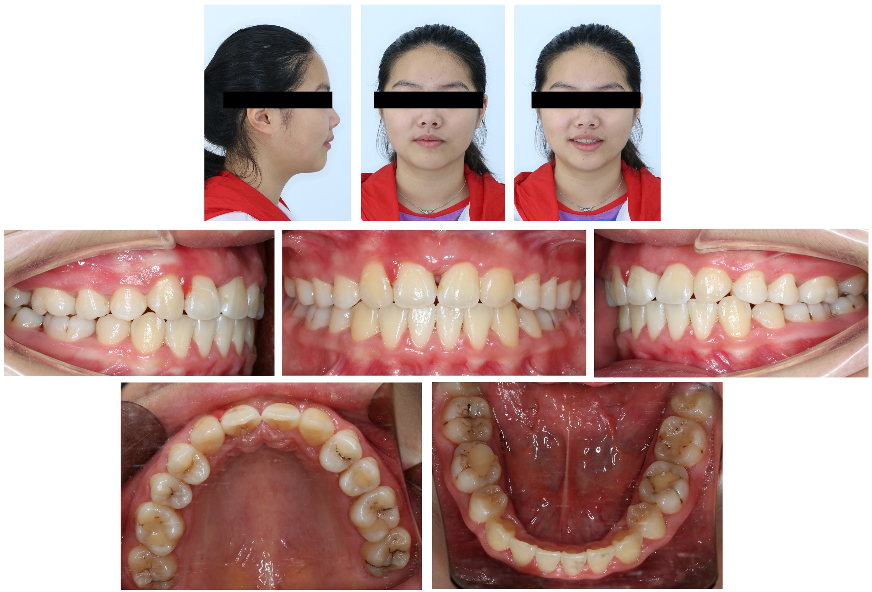 Facial and intraoral photographs showing the results of 
gingival hyperplasia treatment at the 6-month follow-up.