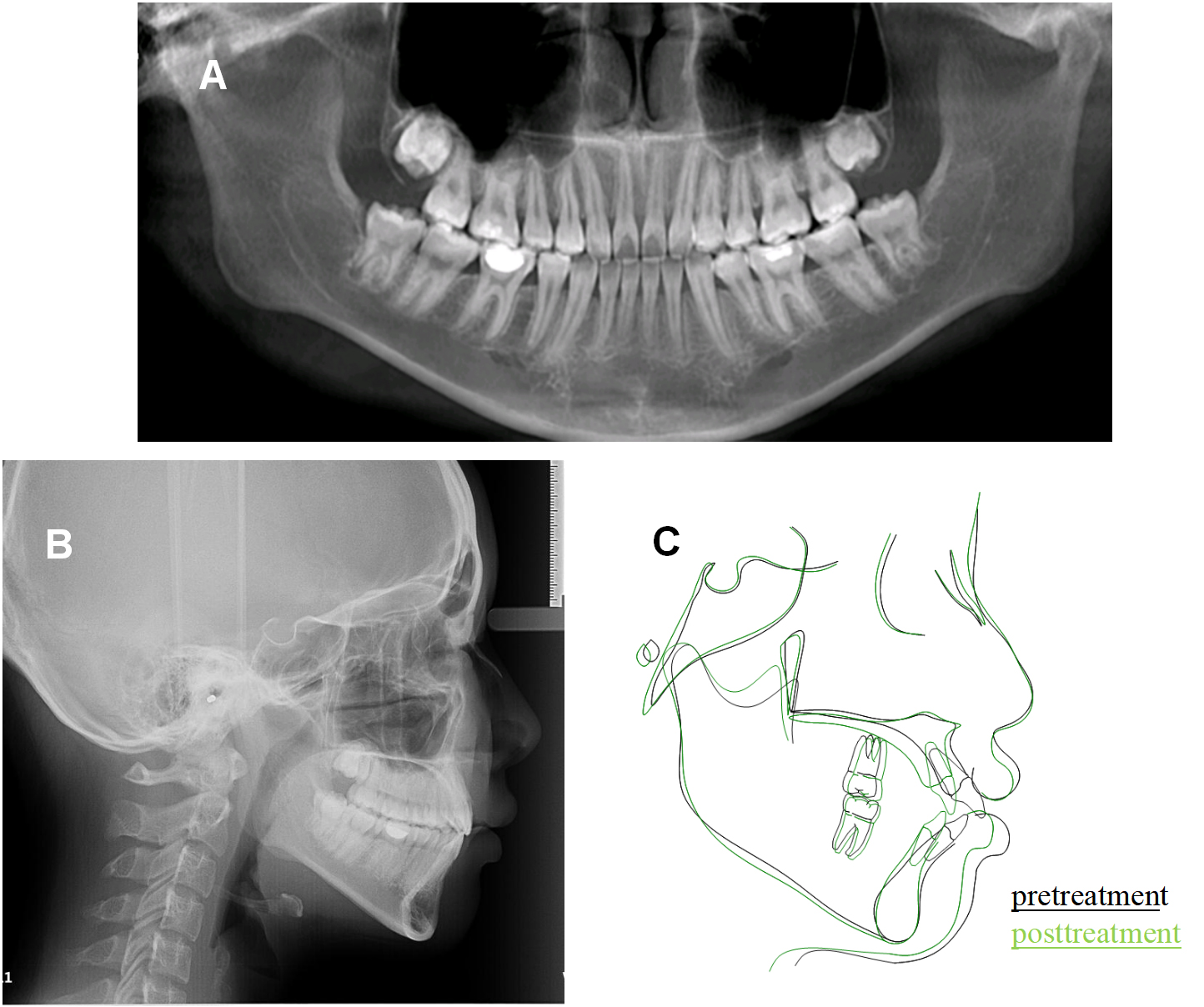 Post-treatment radiographic records and pre-/post-treatment 
cephalometric superimposition. (A) Final panoramic radiograph; (B) Final lateral 
cephalometric radiograph; (C) Superimposition of initial and final cephalometric 
tracings (initial in black, final in green).