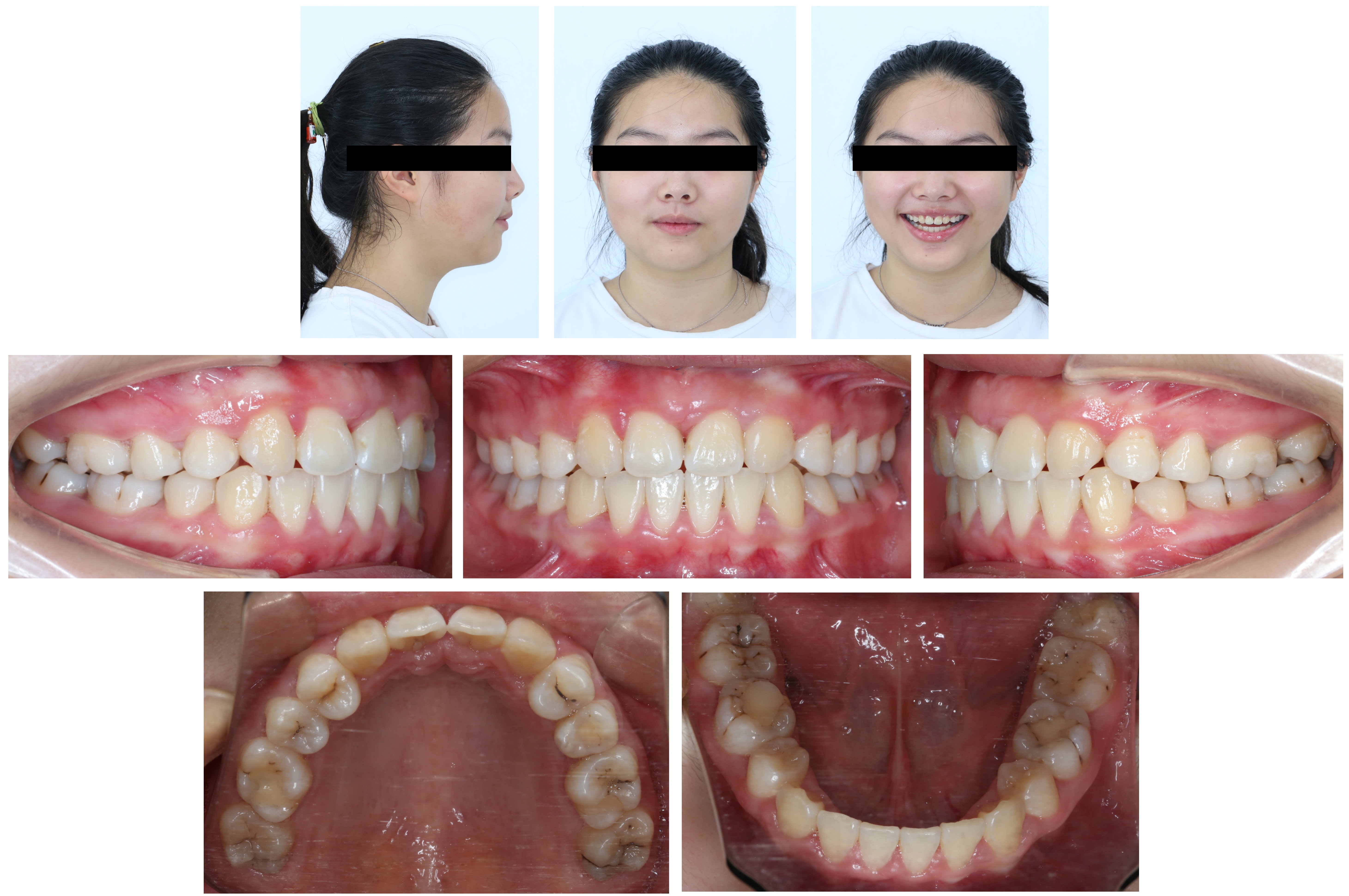 Facial and intraoral photographs at the 2-year follow-up.
