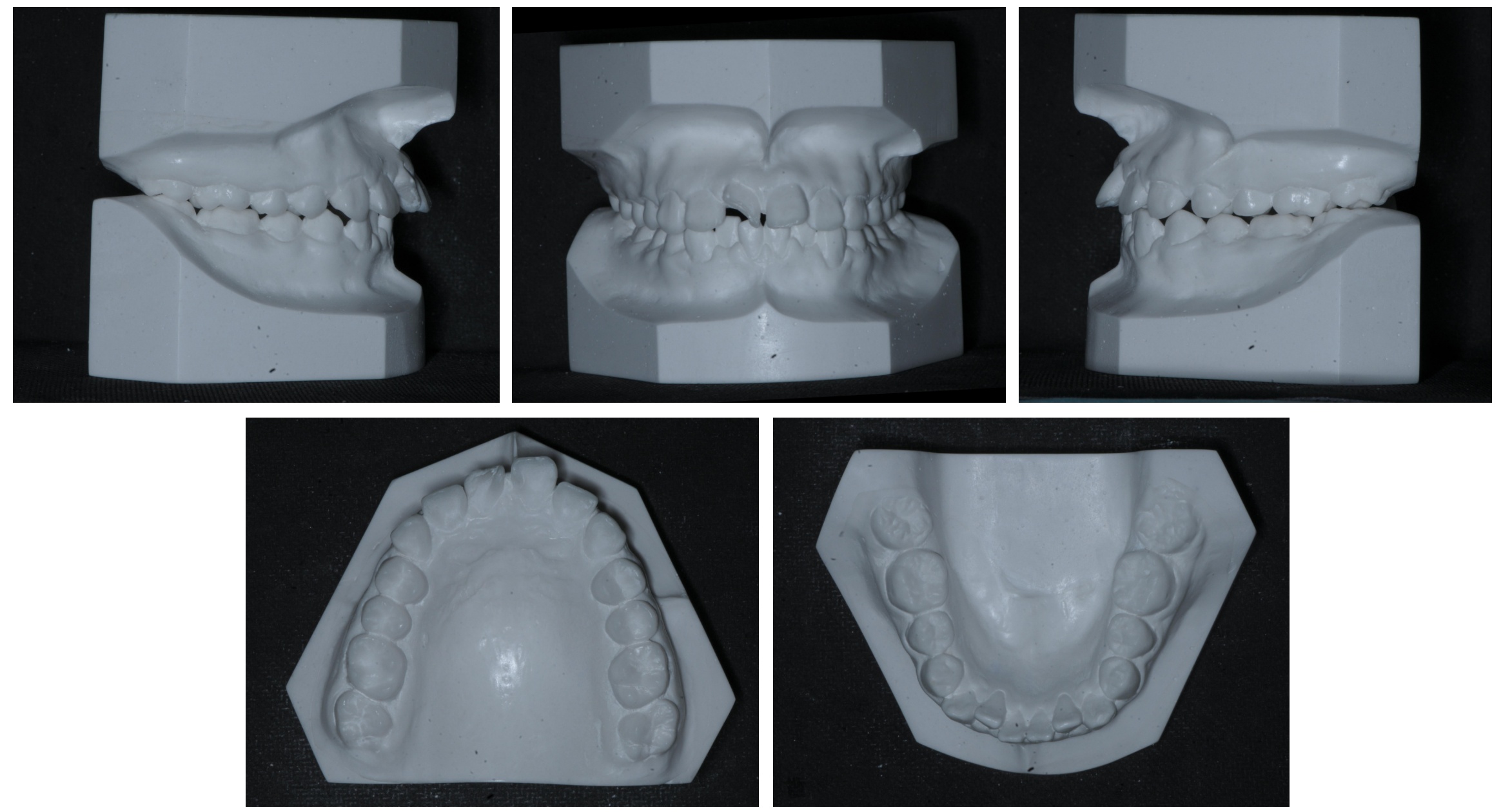Pretreatment dental casts.