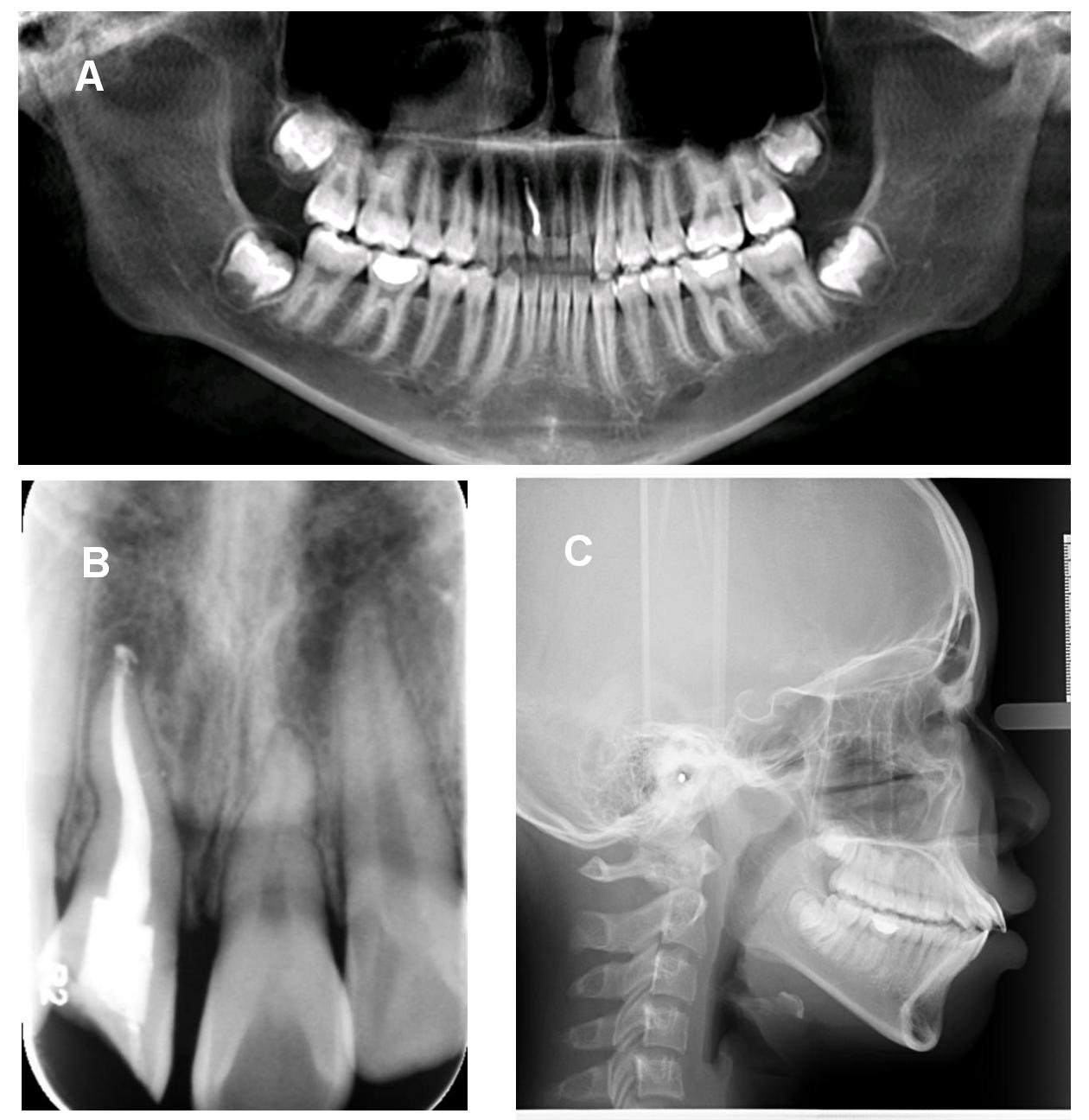 Pretreatment radiographic records. (A) Initial panoramic 
radiograph; (B) Periapical radiograph; (C) Initial lateral cephalometric 
radiograph.