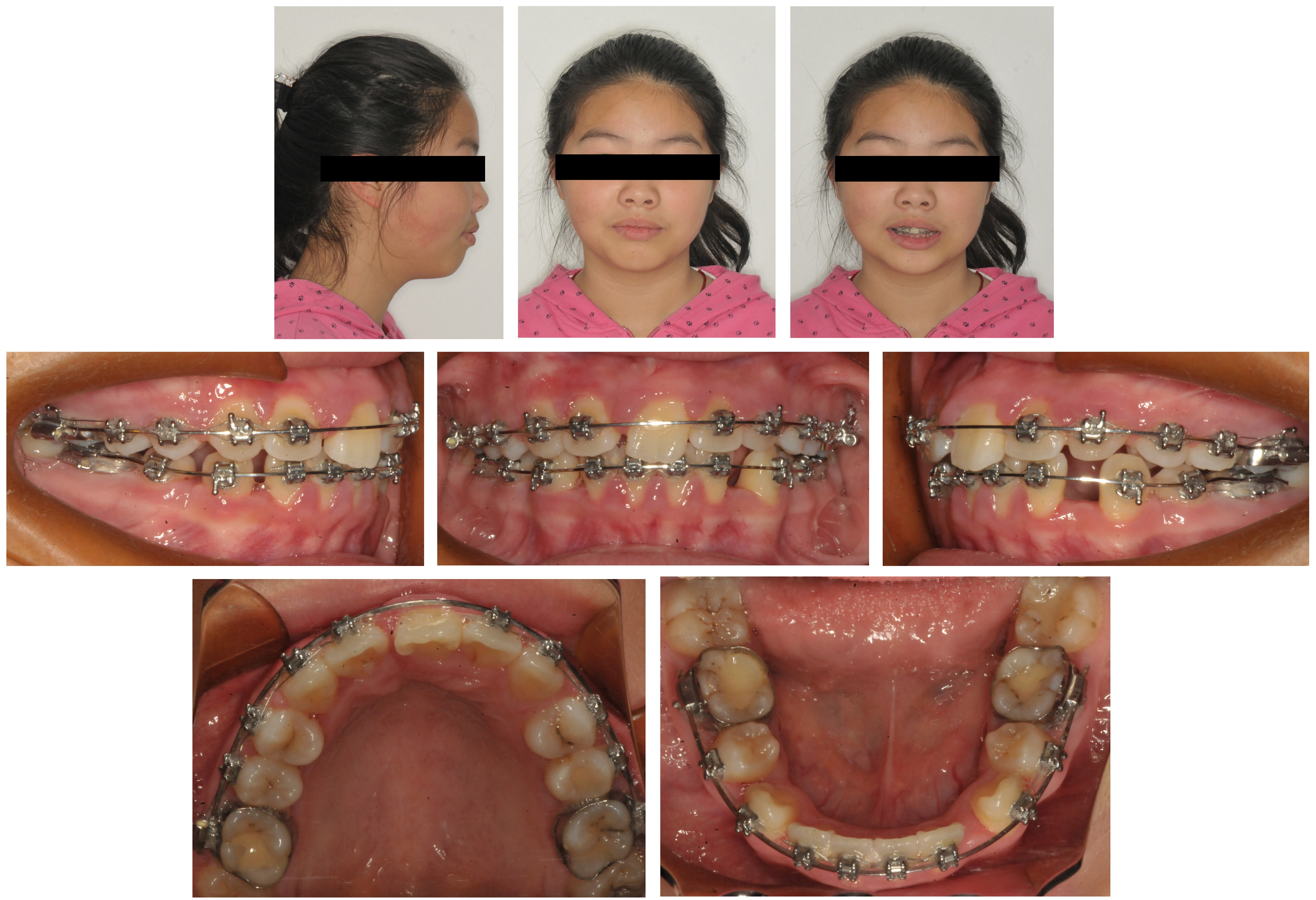 Facial and intraoral progress photographs after extraction of 
the upper right central incisor.