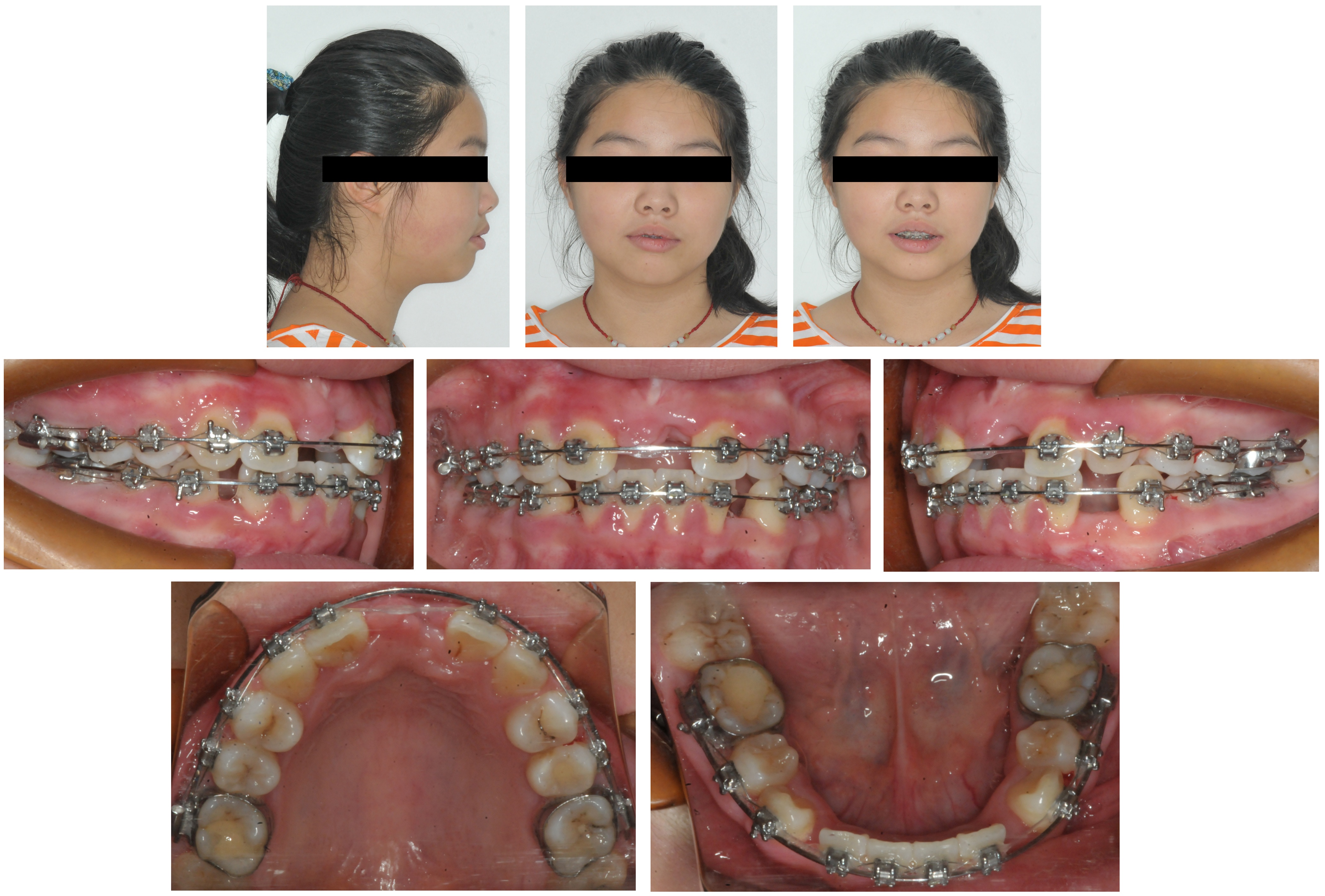 Facial and intraoral progress photographs after extraction of 
the upper left central incisor.