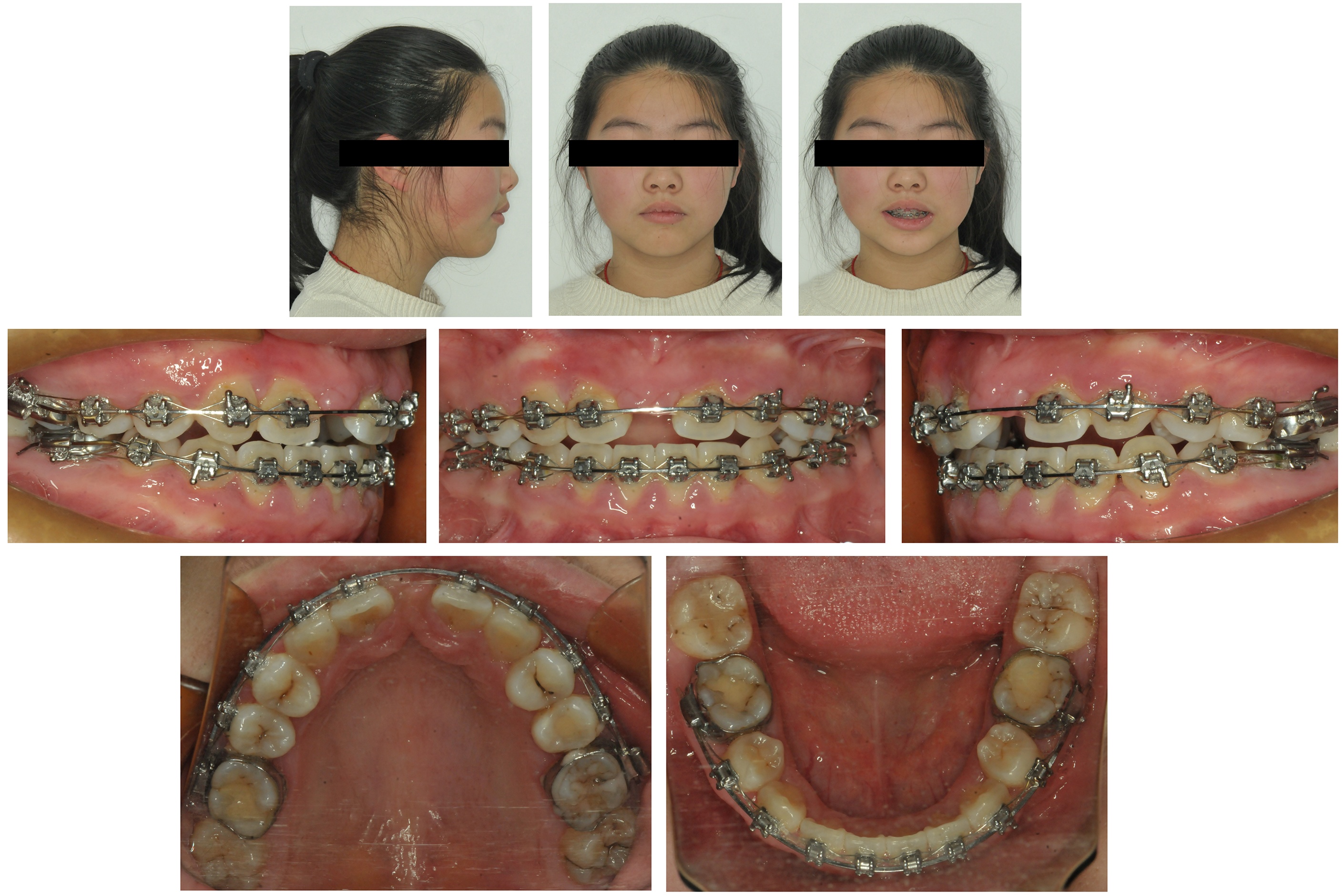 Facial and intraoral photographs 19 months after treatment.