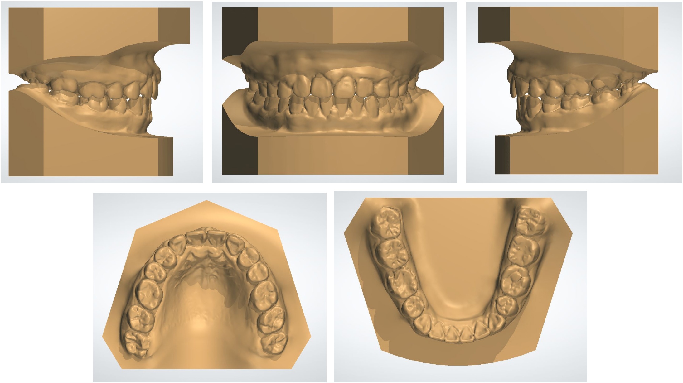 Posttreatment dental casts.