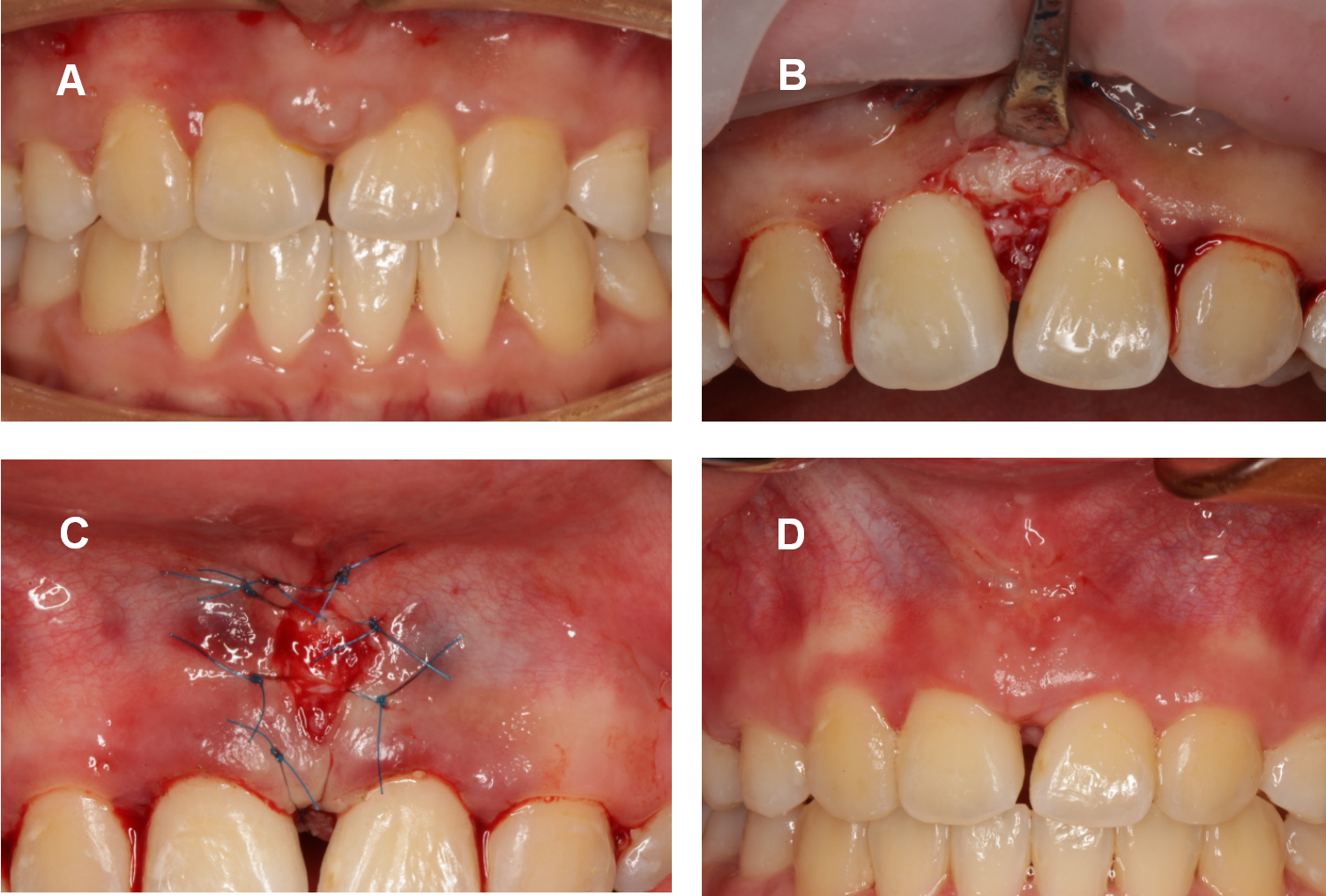Intraoral progress photographs of the gingivoplasty process. (A) 
Hyperplastic tissue before surgery; (B,C) Excision of hyperplastic tissue after 
gingival flap surgery, using a sulcular incision with flap repositioning; (D) 
Twenty days post-surgery.
