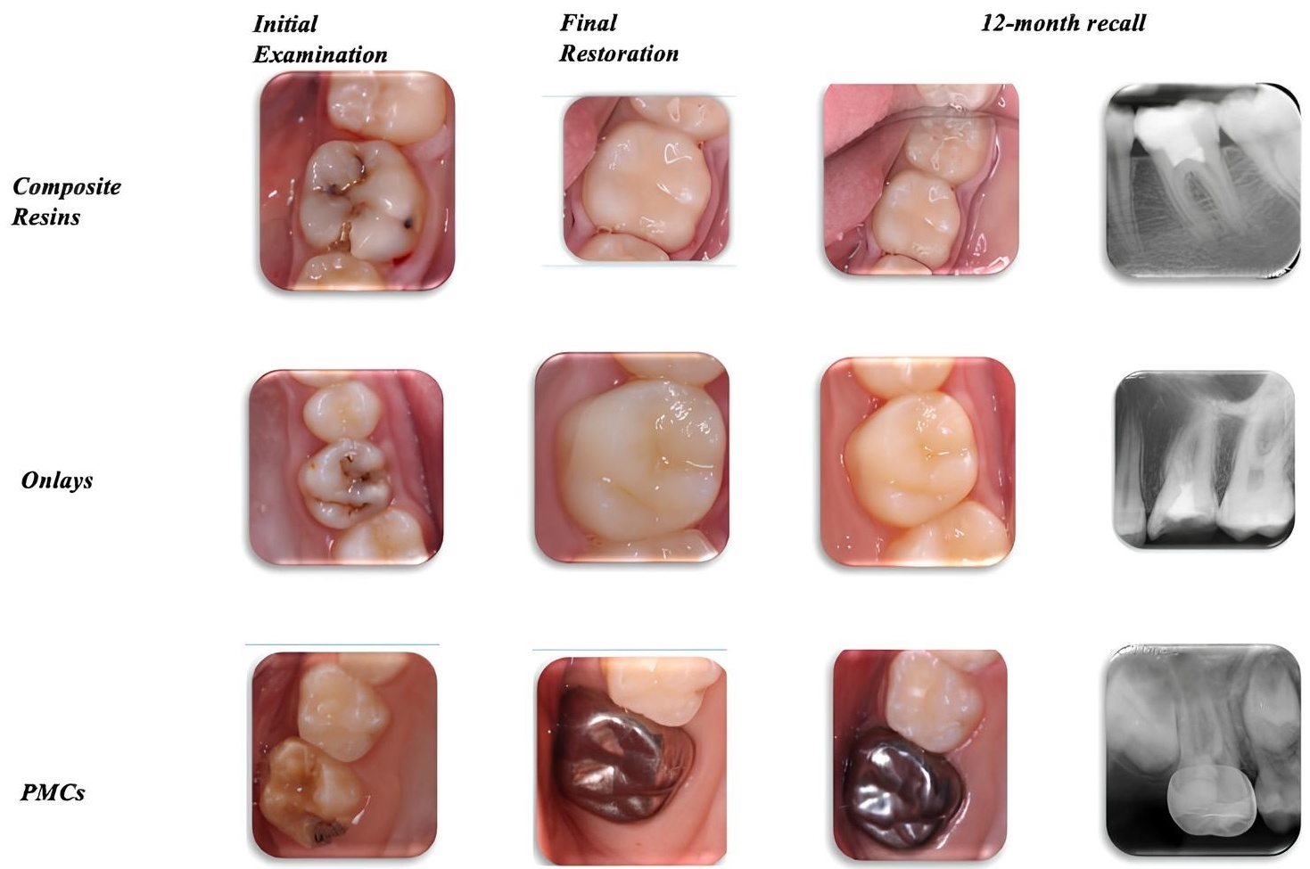 Initial clinical pictures confirming deep caries, followed by
clinical pictures and radiographs following restorative interventions and at
12-months follow-up. PMCs: Preformed metal crowns.