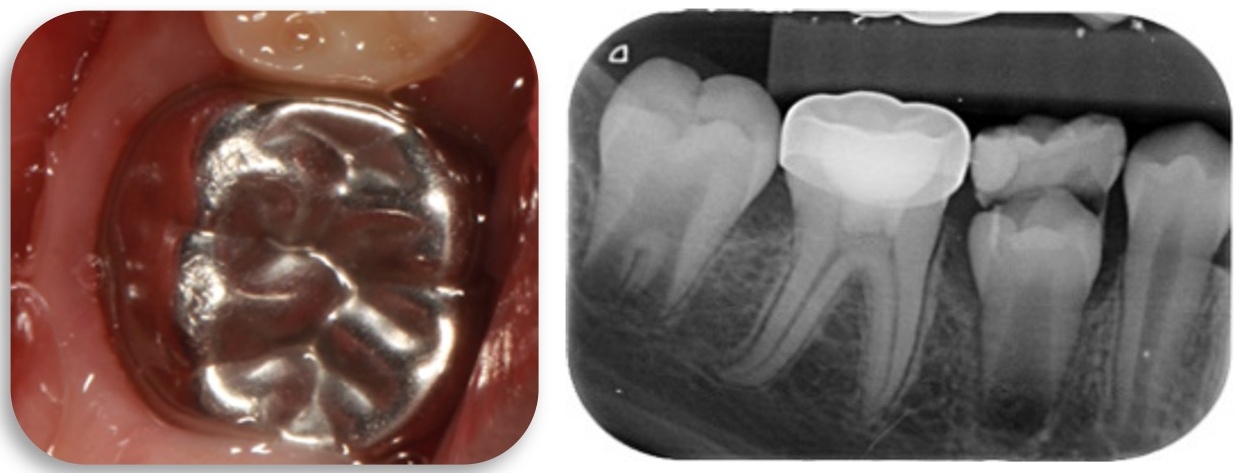 Clinical and radiographic pictures at 6-months follow-up,
indicating a failure of the intervention due to poor fitting and adaptation of a
PMC.