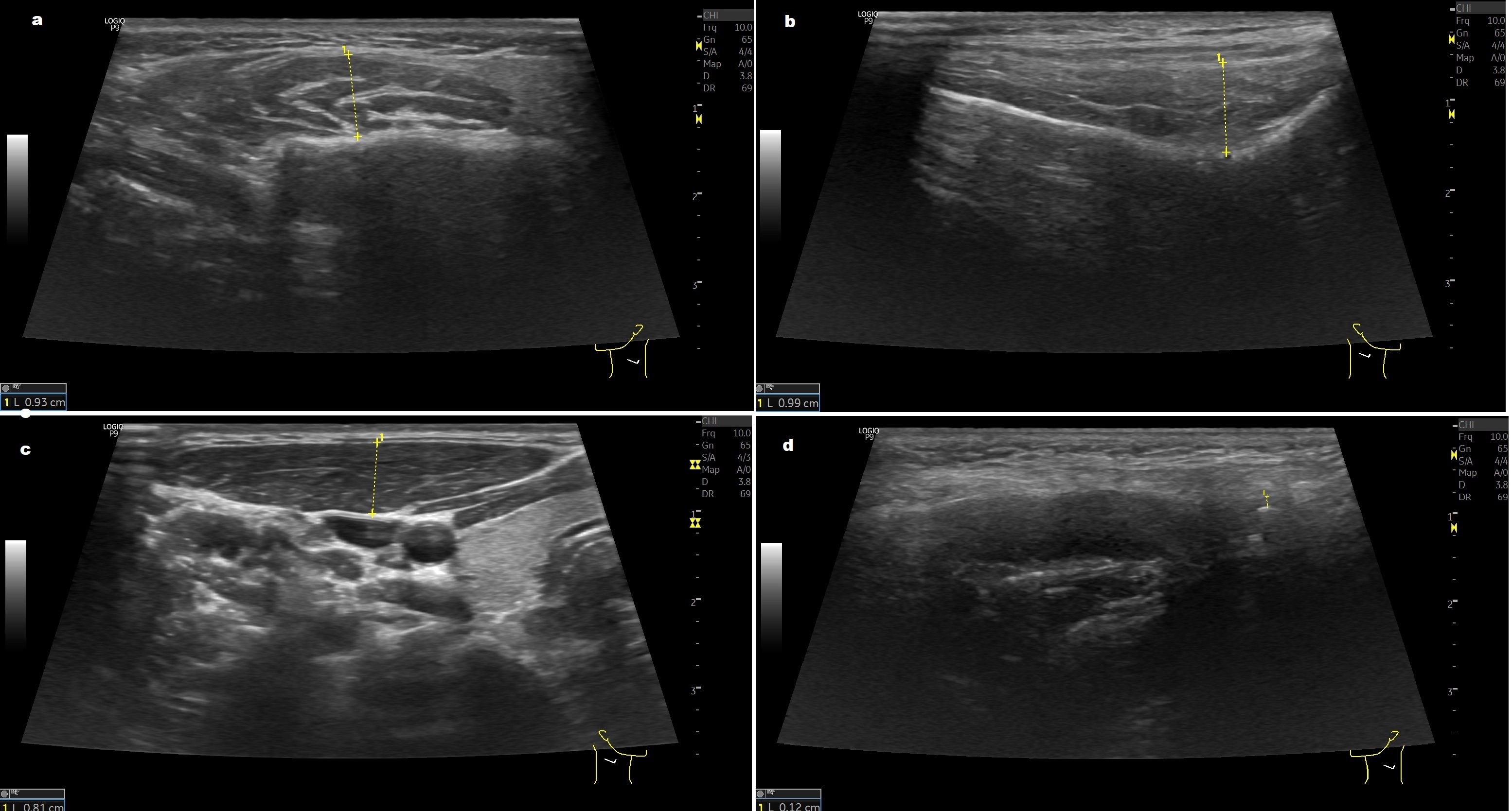 Evaluation of the TMJ in the closed-mouth position showing the
intermediate zone of the articular disc, joint space, and elastography data. (a)
masseter muscle; (b) temporal muscle; (c) sternocleidomastoid muscle; (d) the
intermediate zone of the articular disc.