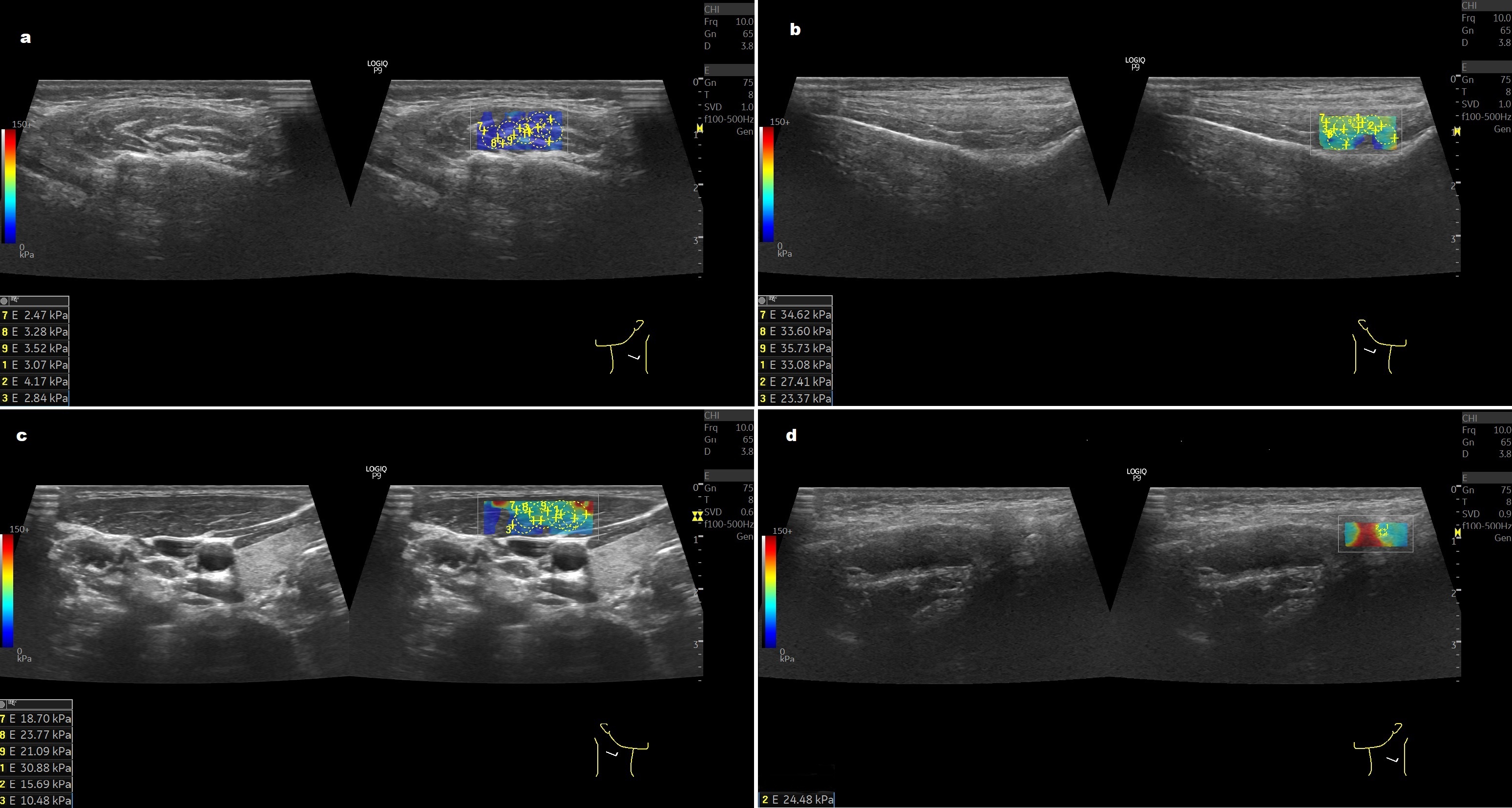 SWE values for the intermediate part of the disc (ADE) were
measured using a 1 mm diameter area in the closed-mouth position. (a) masseter
muscle; (b) temporal muscle; (c) sternocleidomastoid muscle; (d) the intermediate
zone of the articular disc.
