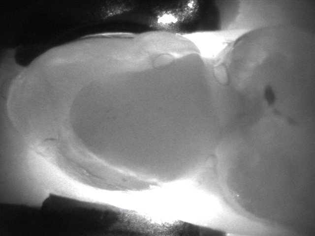 Sample diagnostic image showing a filling and an adjacent carious lesion
on the mesial surface (photo by authors).