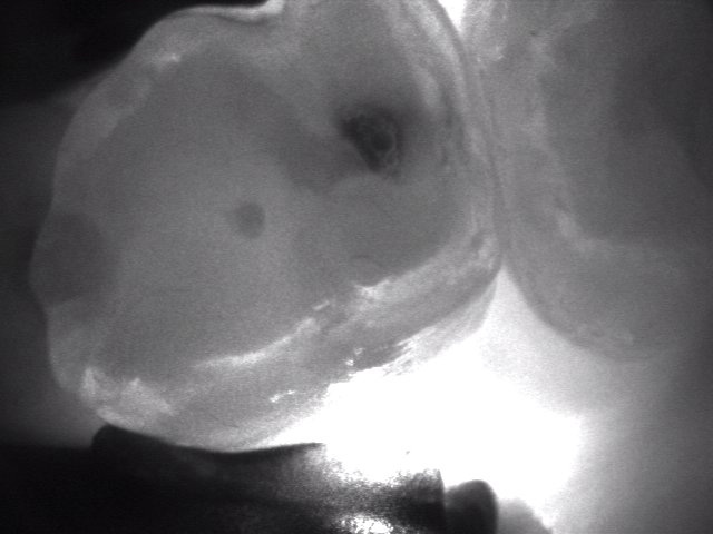 Diagnostic image showing a filling on the mesial surface and occlusal
caries in a primary molar (photo by authors).