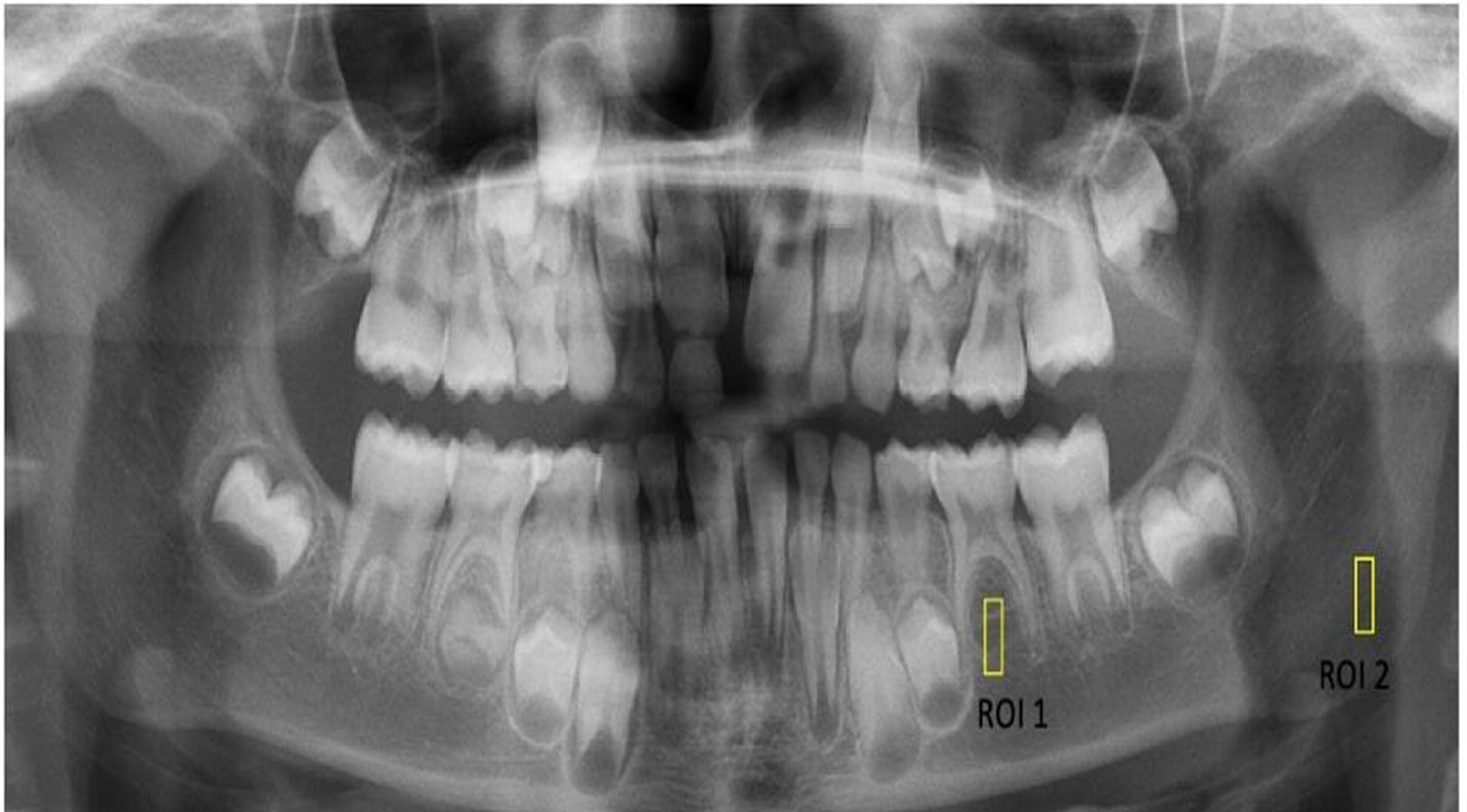 Selection of ROI 1 and ROI 2 on a panoramic radiograph. ROI:
region of interest.