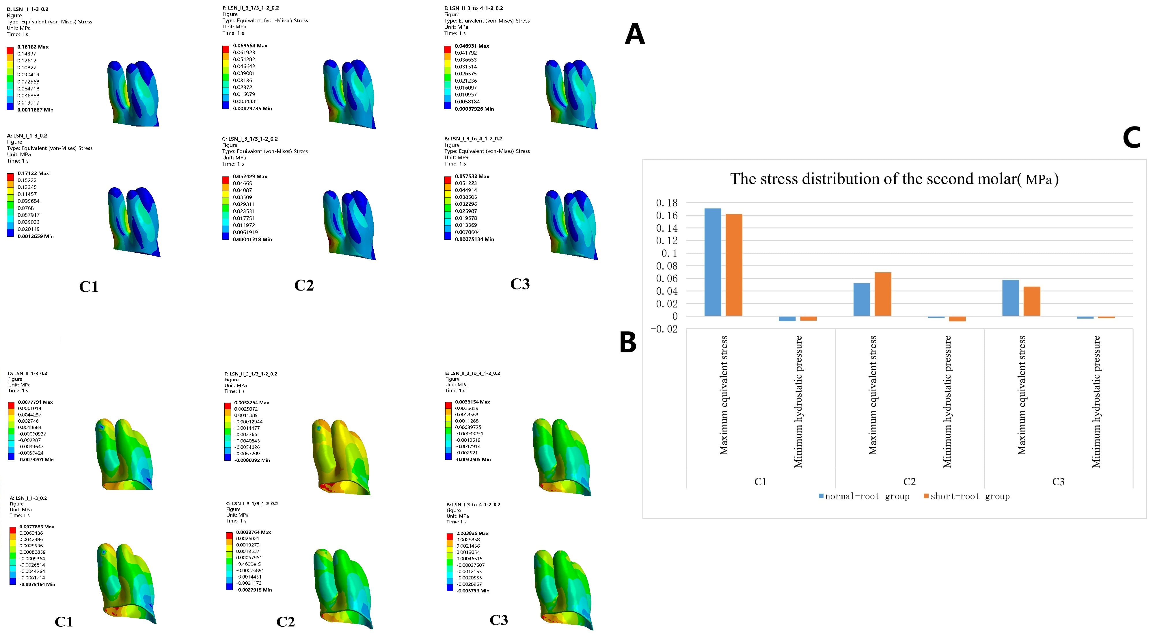 Stress distribution of the second molar. (A) The largest von
Mises stress of the second molar was identified in the distal root area. (B) The
minimum hydrostatic pressure was detected in the mesial cervical area. (C) The
highest stress distribution of the first molar was observed in C1, while the
lowest stress occurred in C2. Max: maximum; Min: minimum.