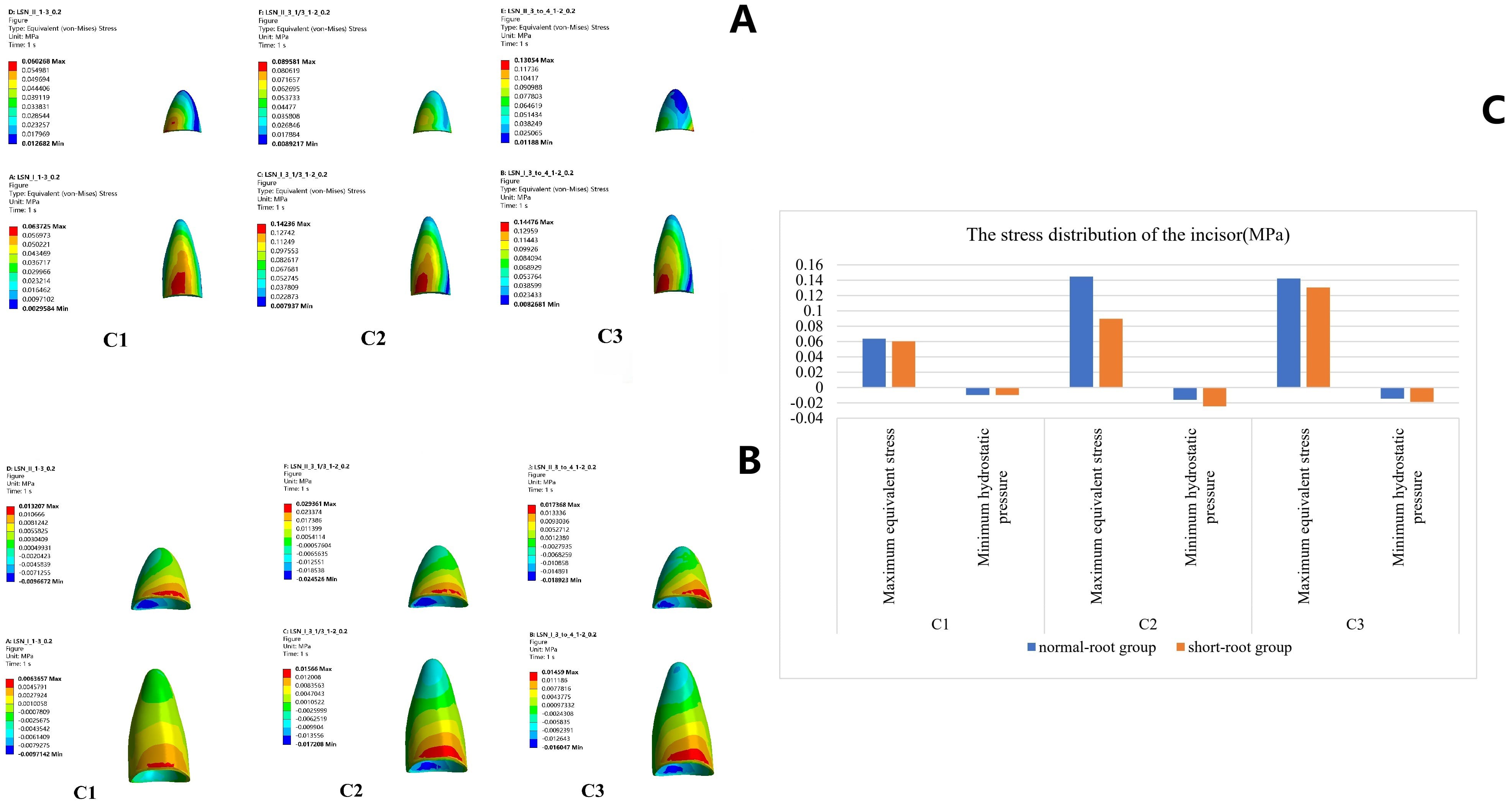 Stress distribution of the central incisor. (A) The largest von
Mises stress was observed in the central incisor cervical area. (B) The minimum
hydrostatic pressure was detected in the lingual cervical area. (C) The lowest
stress distribution of the central incisor occurred in C1, the highest stress in
C2. There was no significant difference in stress between the two groups under
C1. Max: maximum; Min: minimum.